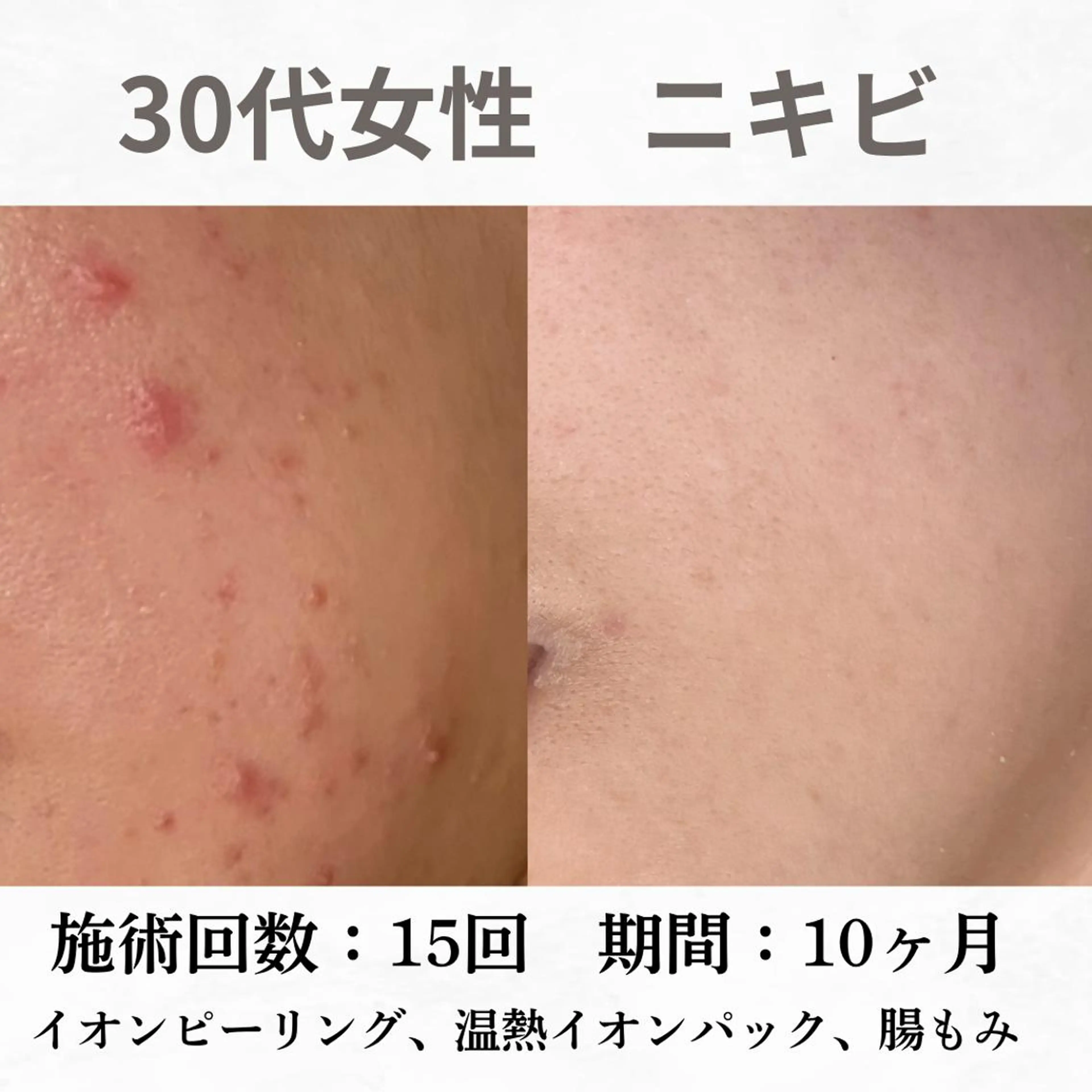 重度ニキビ専門🌷 ダウンタイムなしのエステ・リラクイメージ