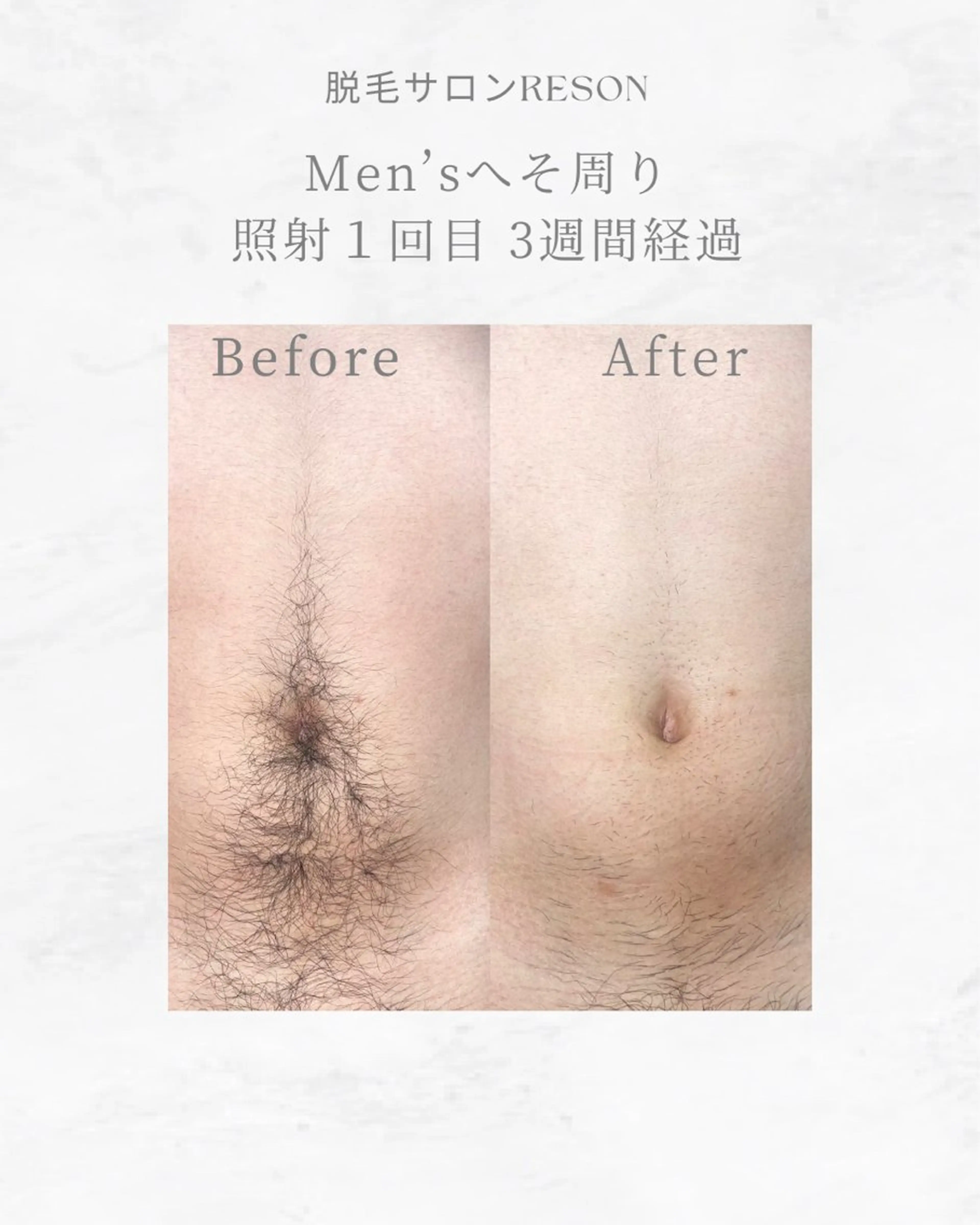 メンズフル脱毛の写真