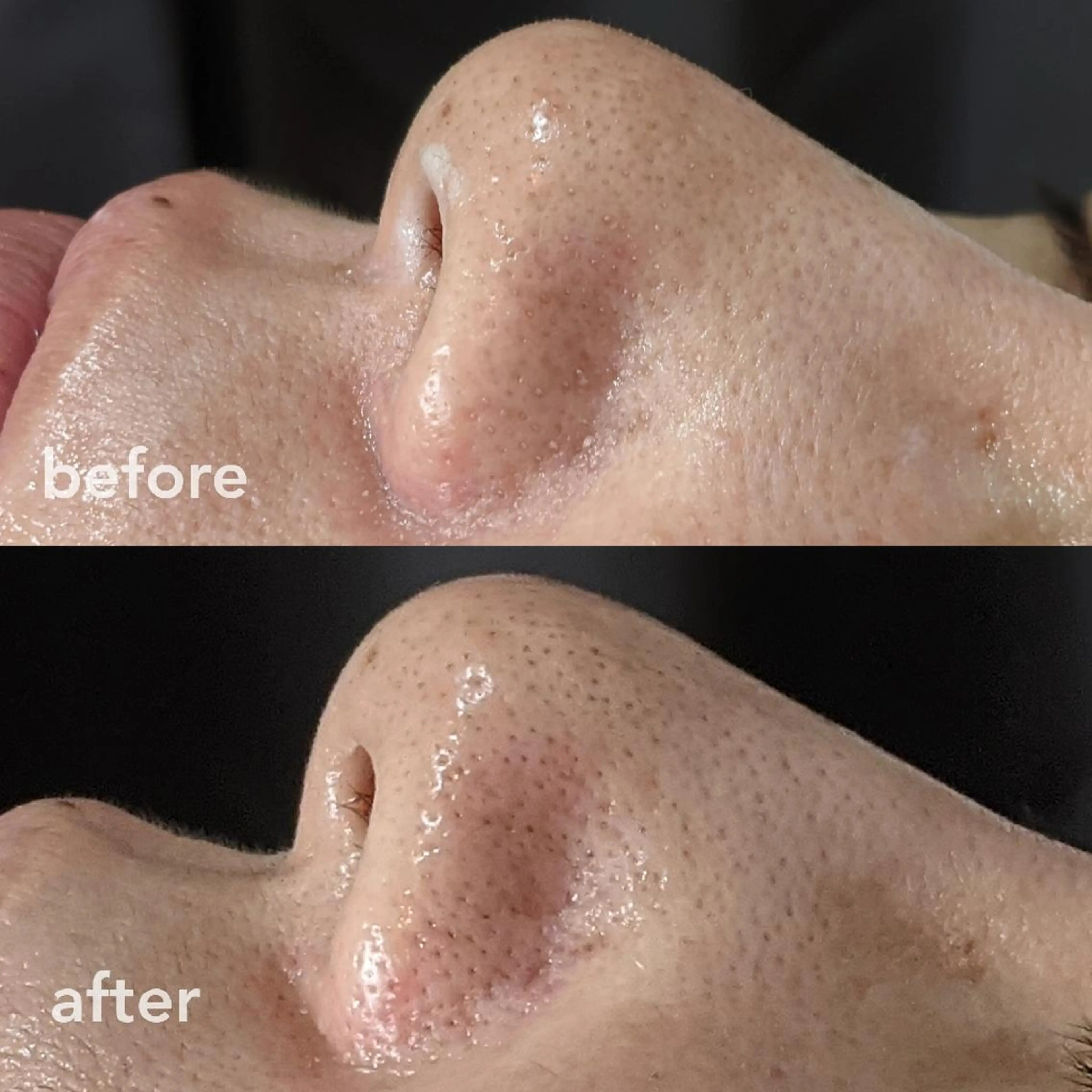 【フェイシャル】毛穴ケアの写真