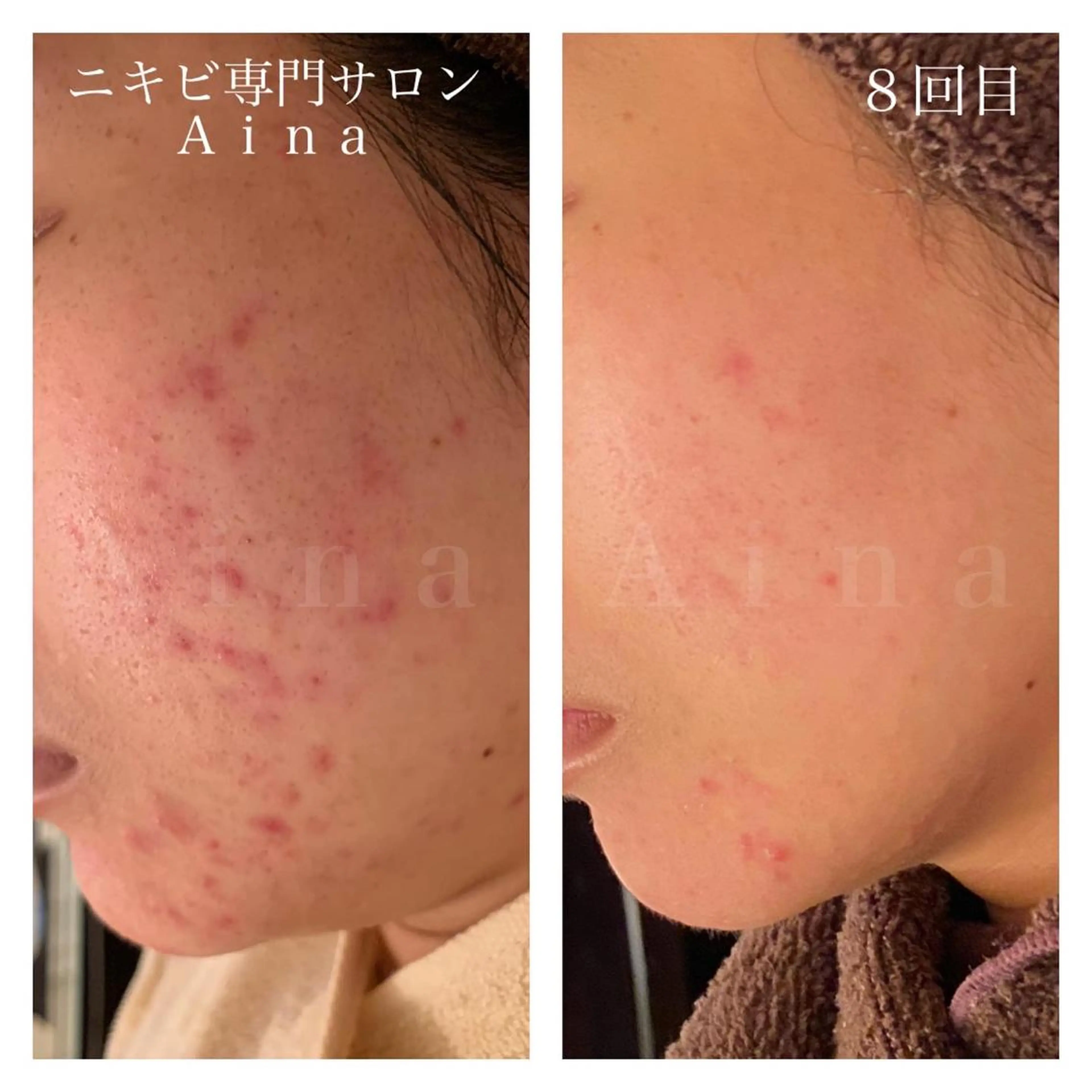 セミロング パーマ ヘアアレンジ メンズ キッズ ネイル マツエク・マツパ 赤色 ニキビ跡専門サロン Ainaのエステ・リラクイメージ