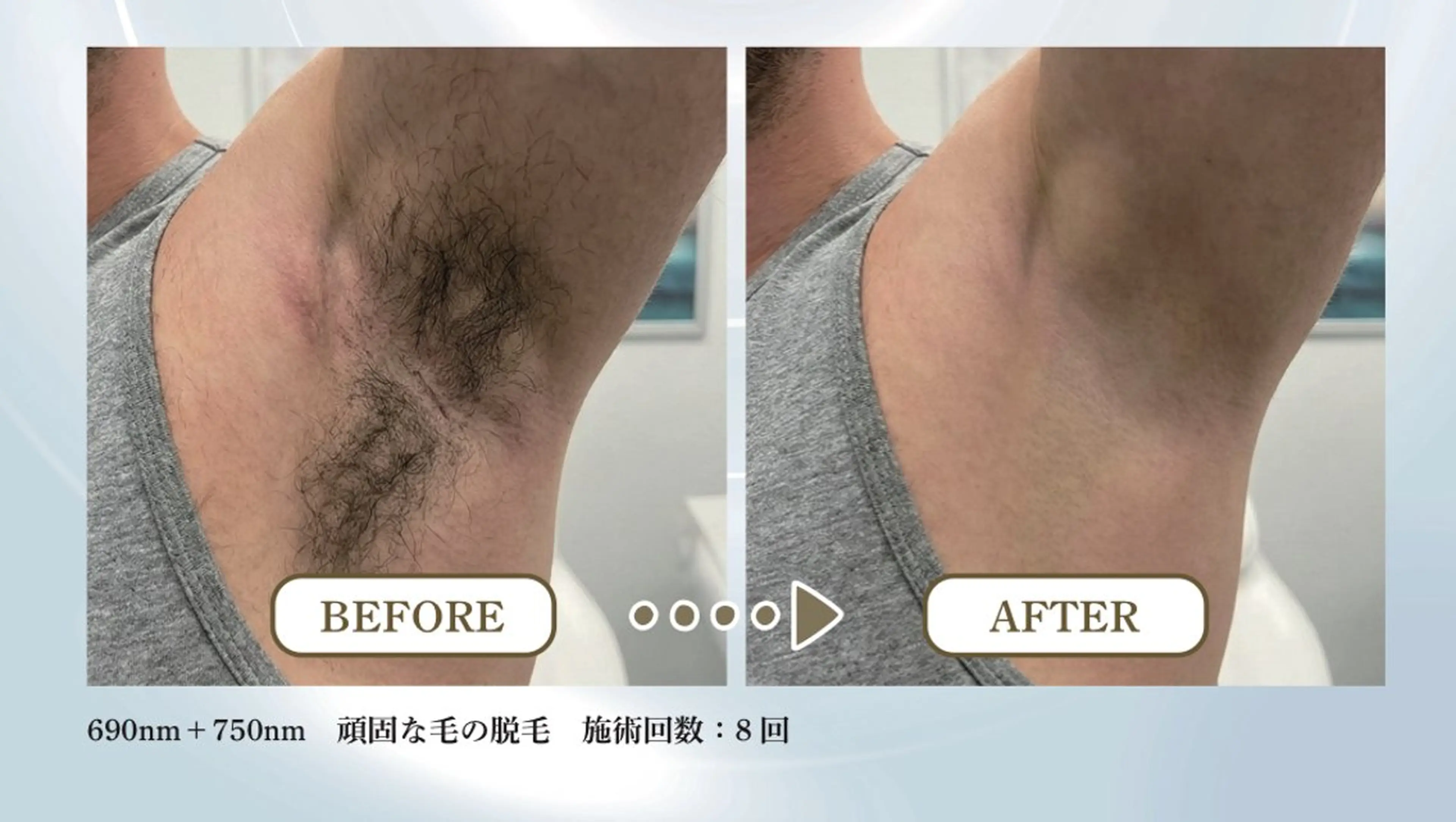 メンズワキ脱毛の写真