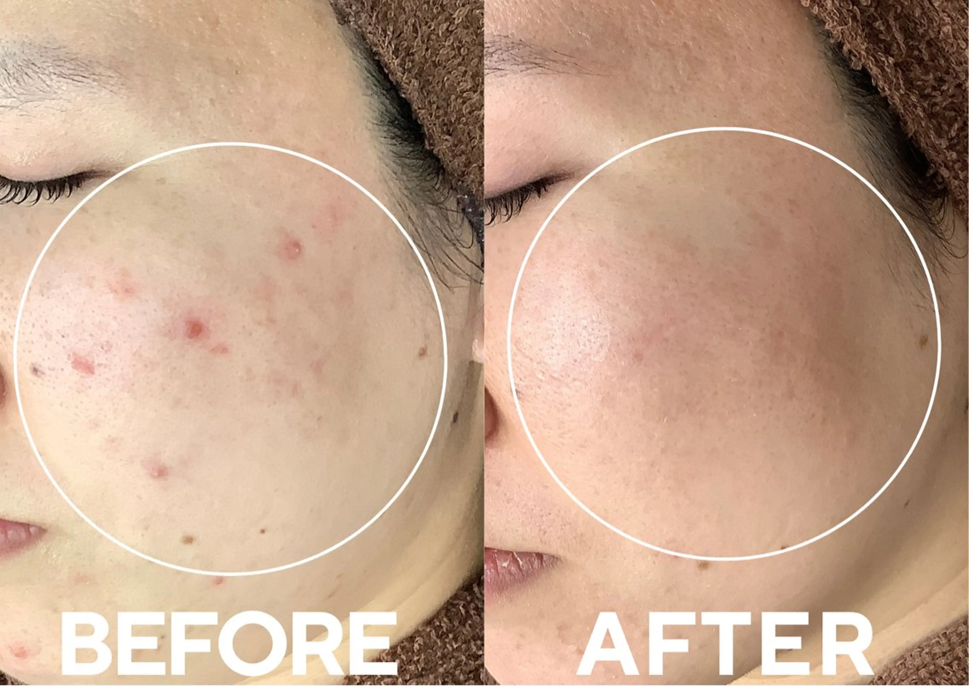 【 ニキビケア 】繰り返すニキビに◎肌質改善コースの写真