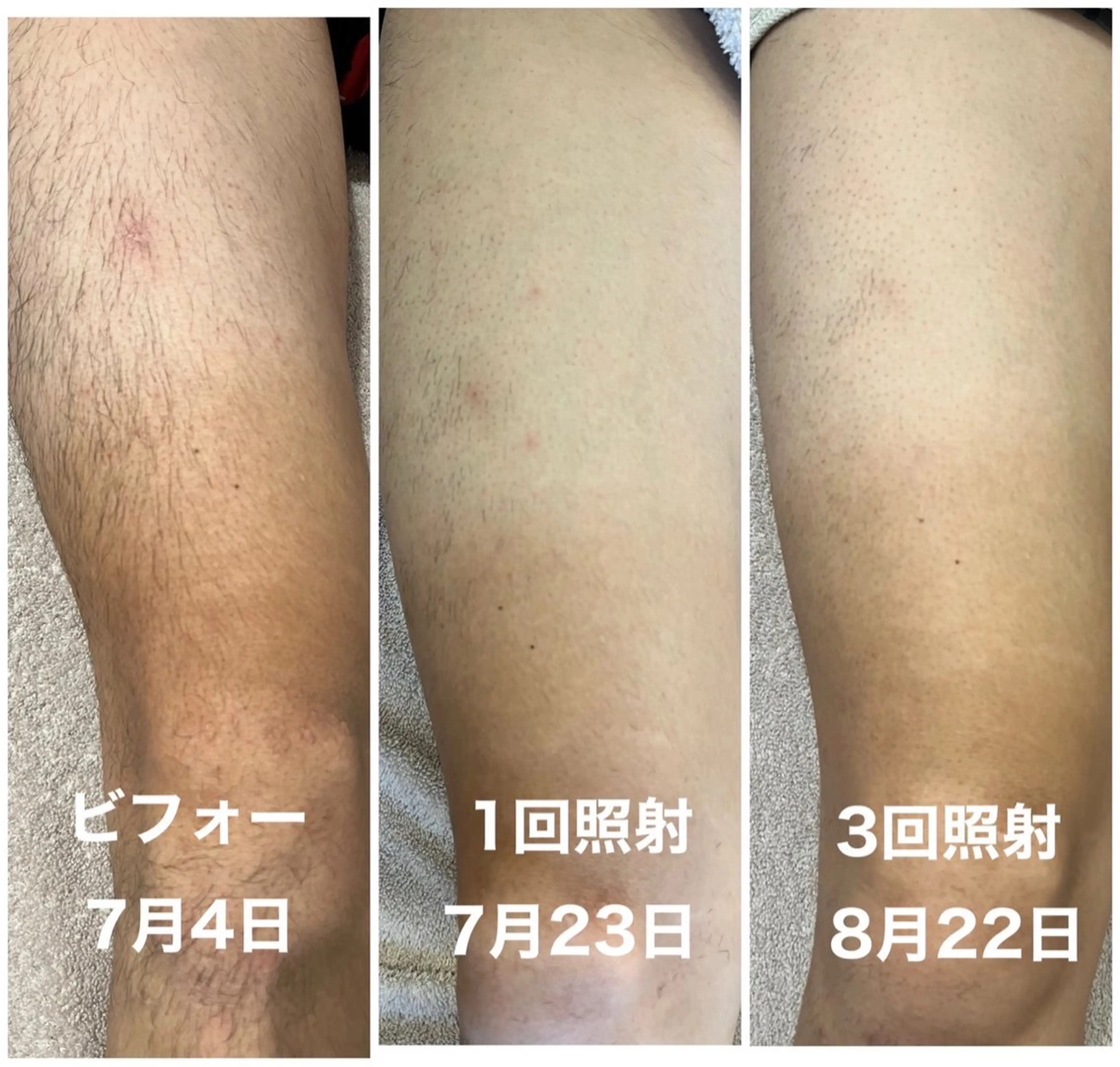 脱毛 yukinoのエステ・リラクイメージ