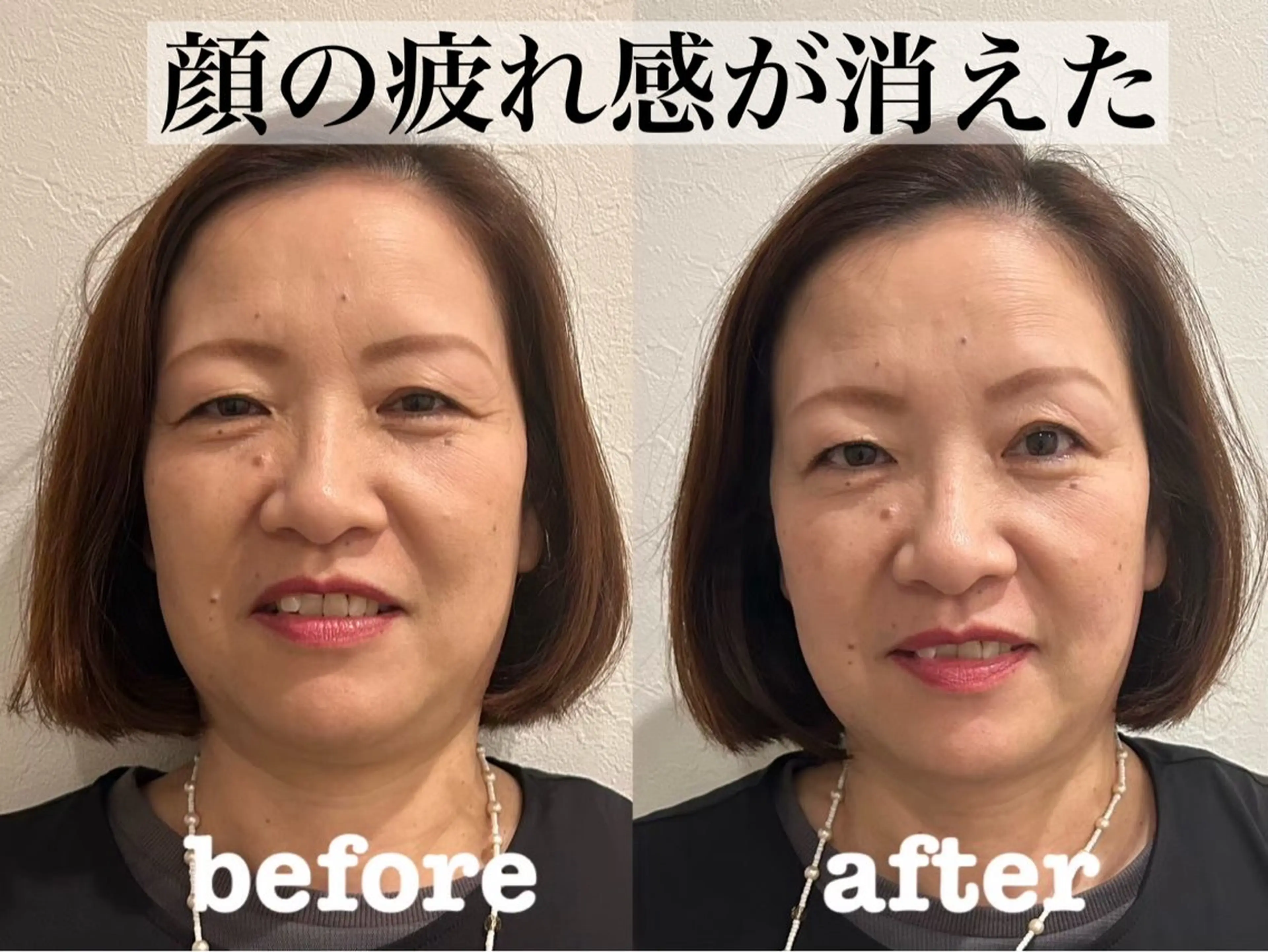 エステ リラク 肌質改善×美容鍼 ゆいのエステ・リラクイメージ