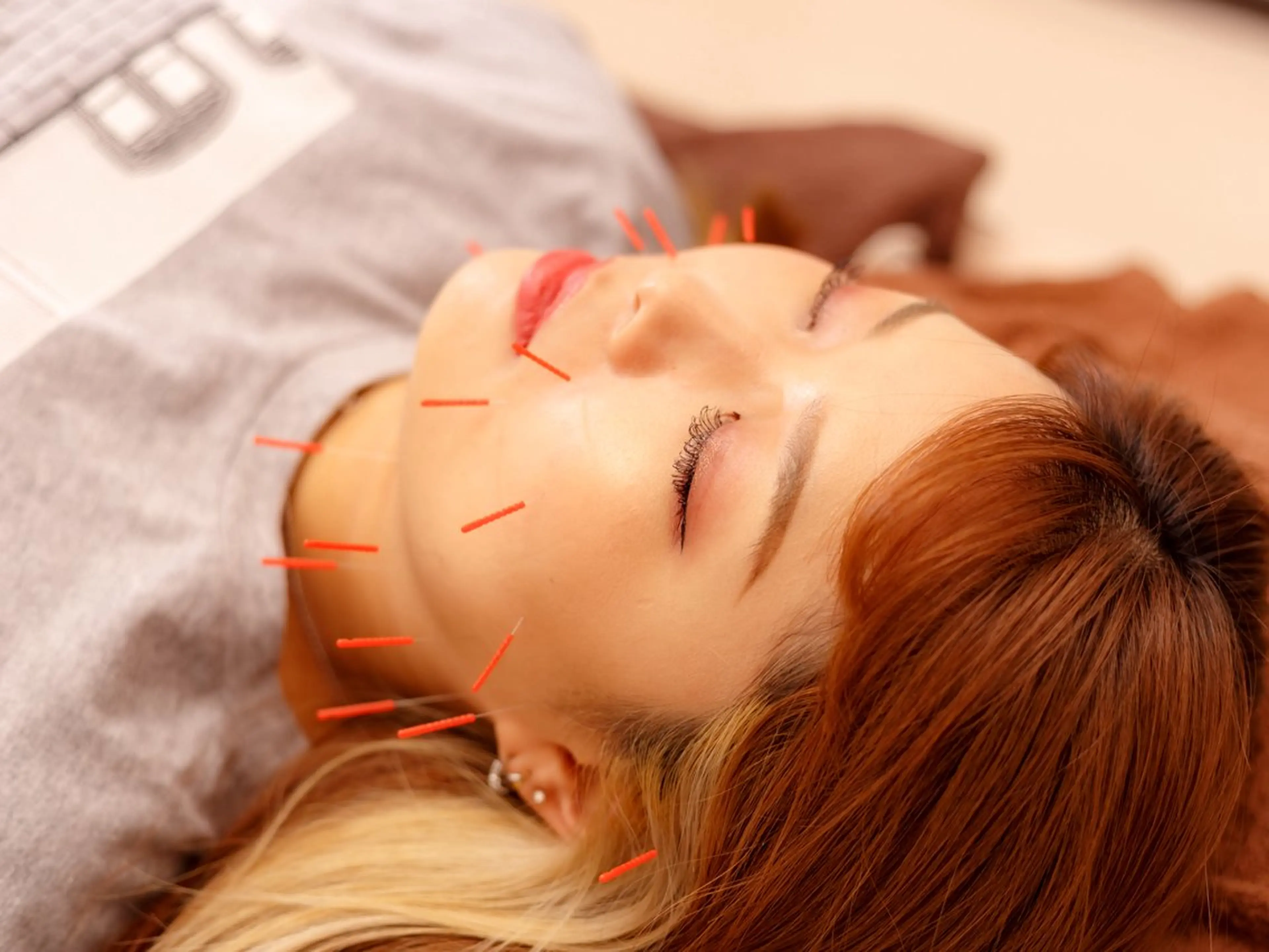 フェイスラインを集中美容鍼の写真