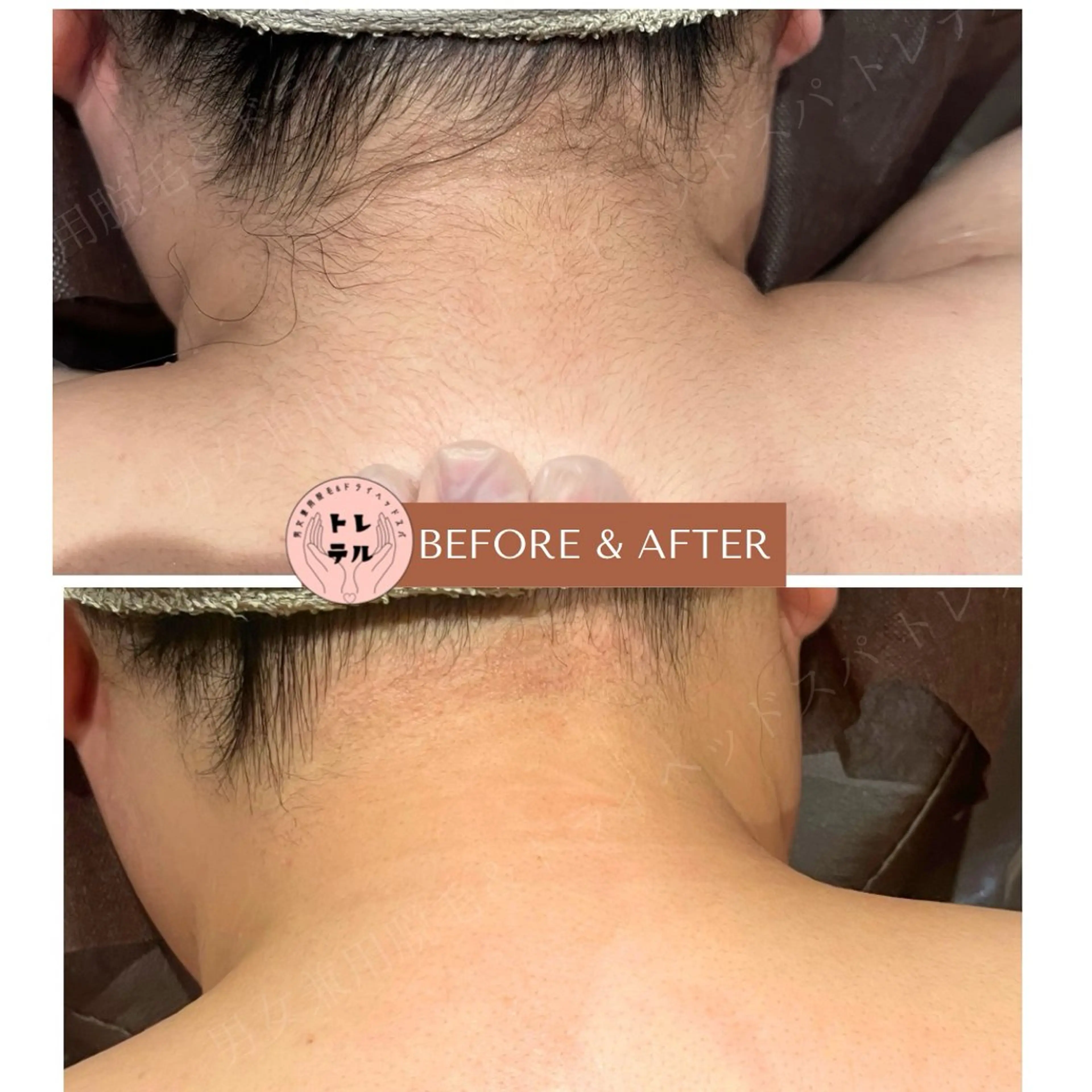 脱毛 男女兼用脱毛＆ドライ ヘッドスパ トレテルのエステ・リラクイメージ