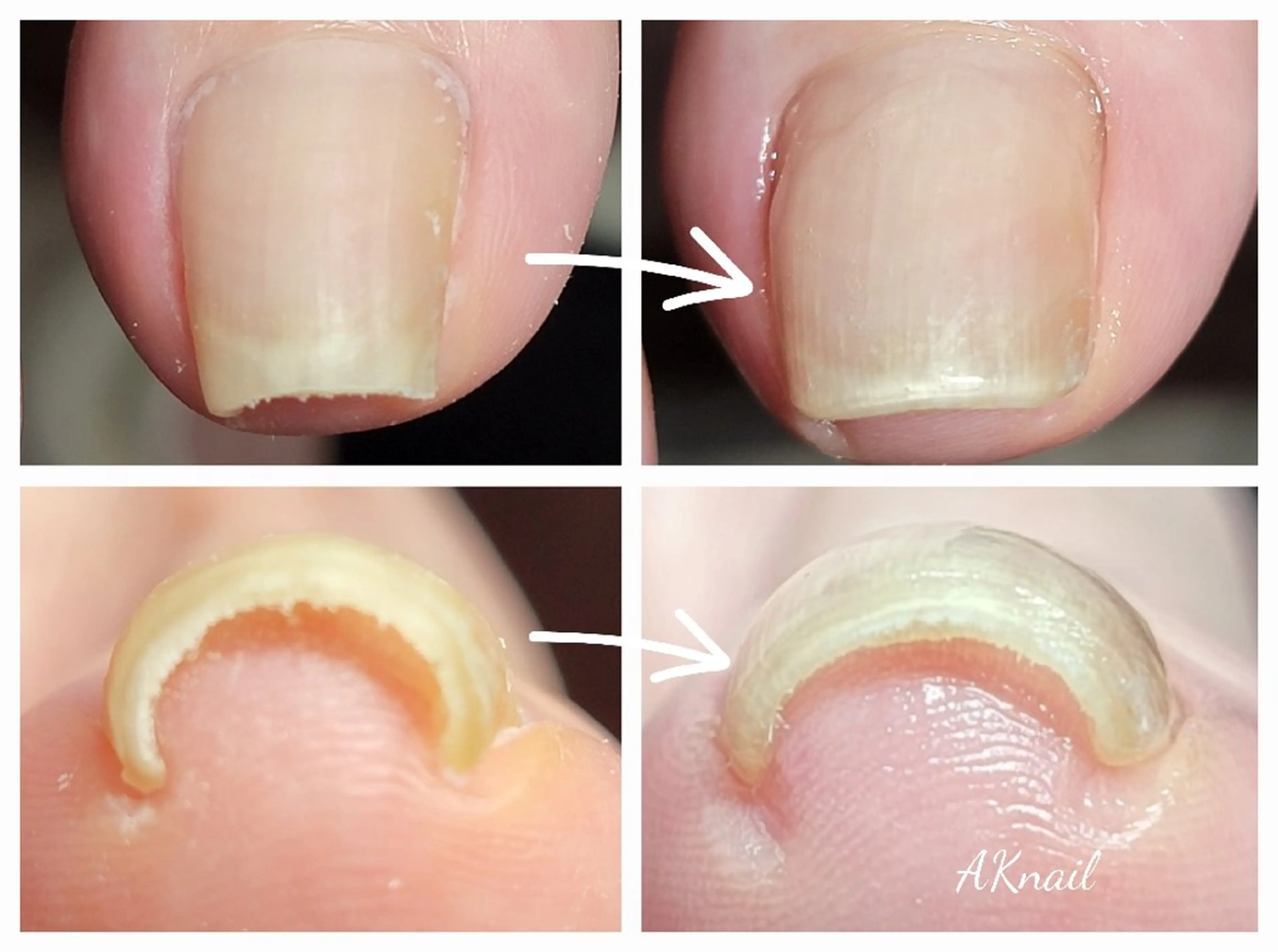 ネイル&巻き爪サロン AKnailのネイルデザイン