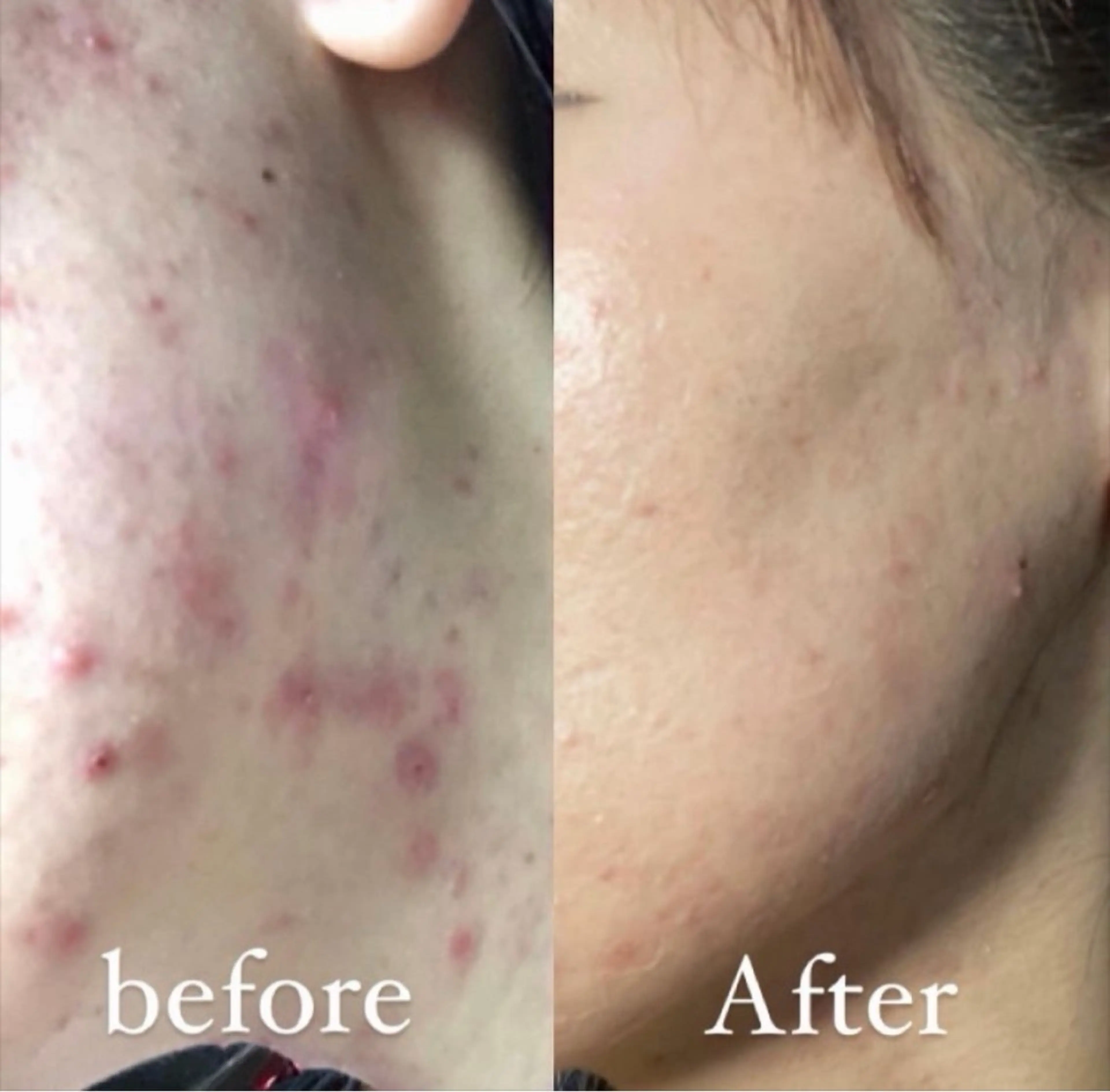 【本気肌質改善】HAABREPRO ハーブピーリング¥10,000-の写真