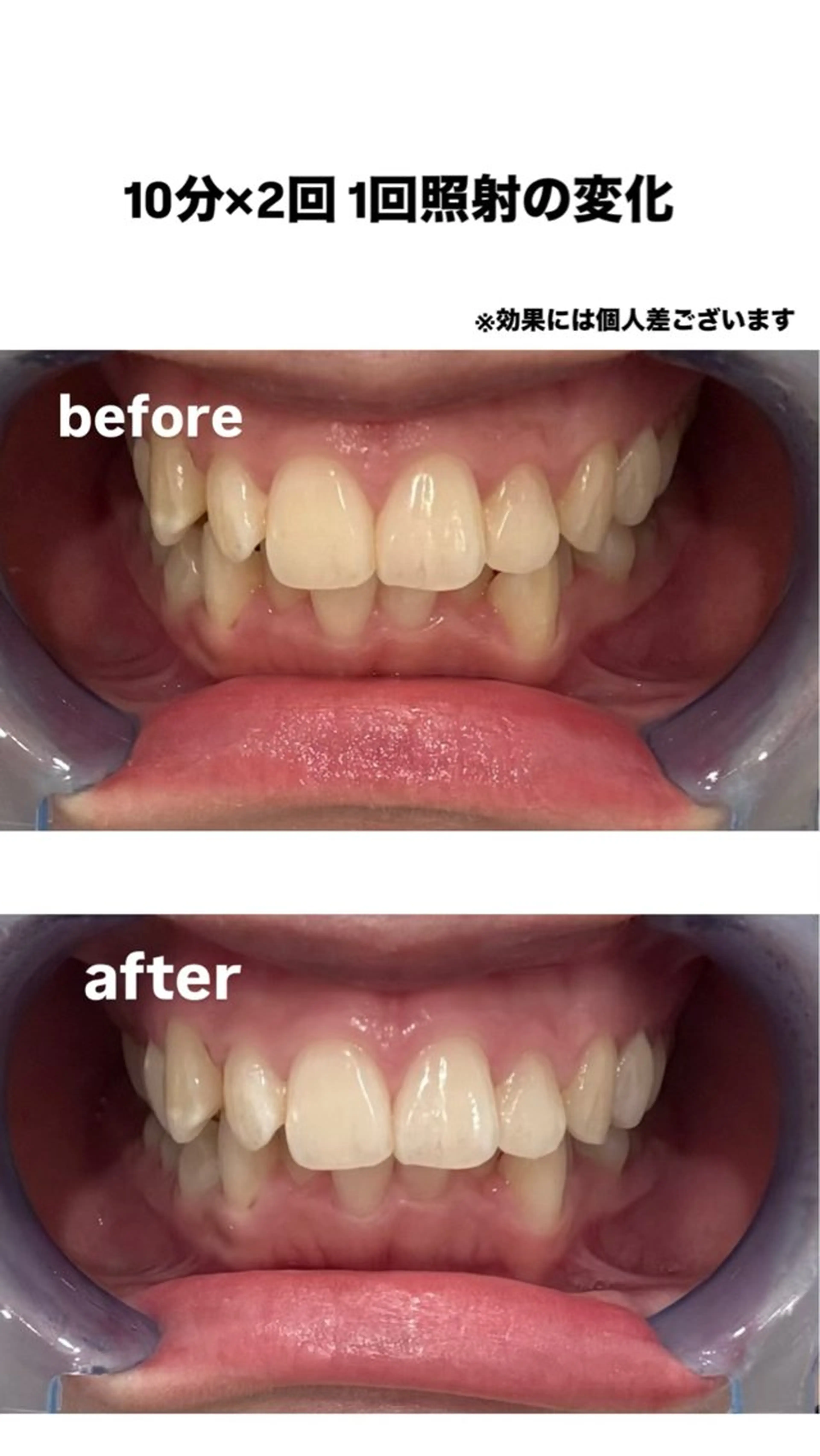 歯のホワイトニング10分×2回　3回回数券の写真