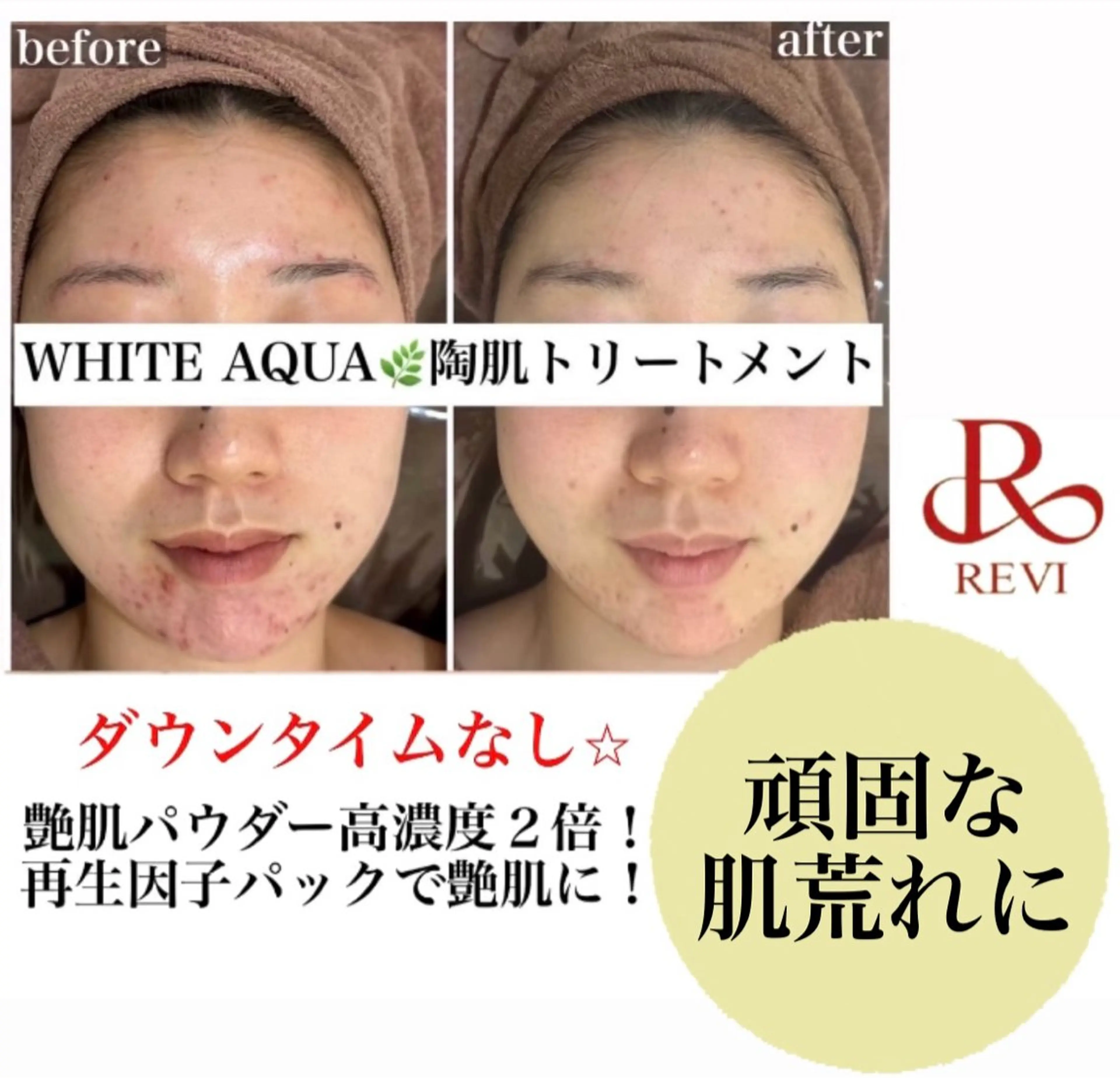 White Calm 天王寺所属・ハーブピーリング White Calmのその他イメージ