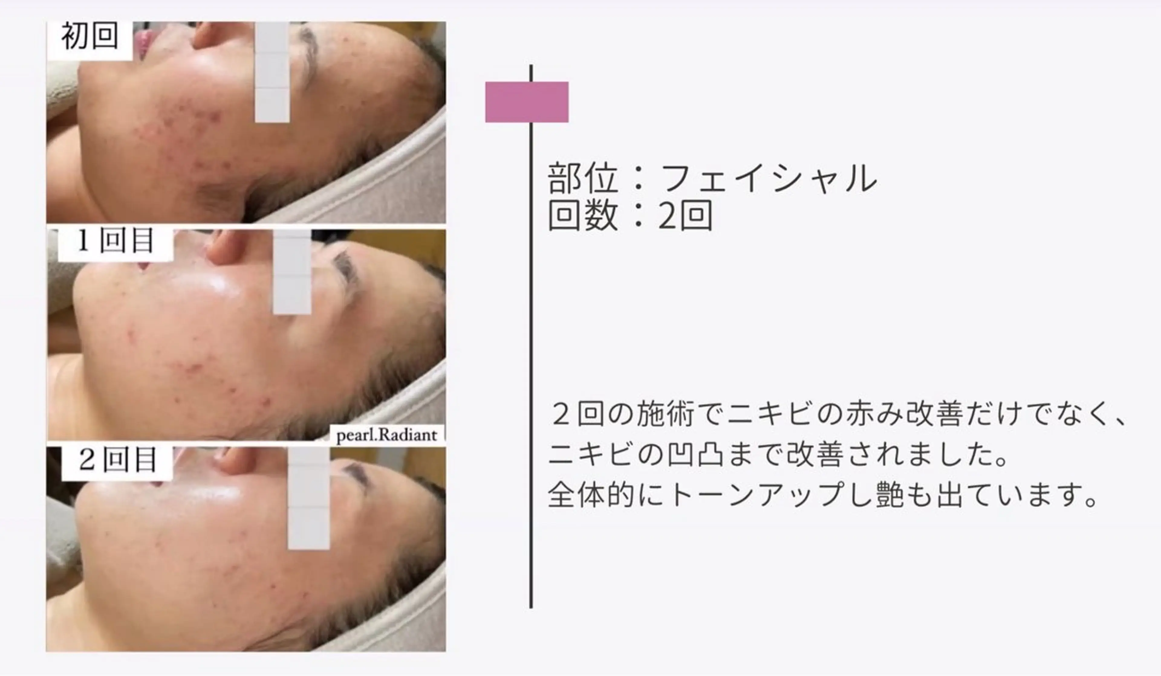 エステ 艶肌ワックス ALLY.のエステ・リラクイメージ