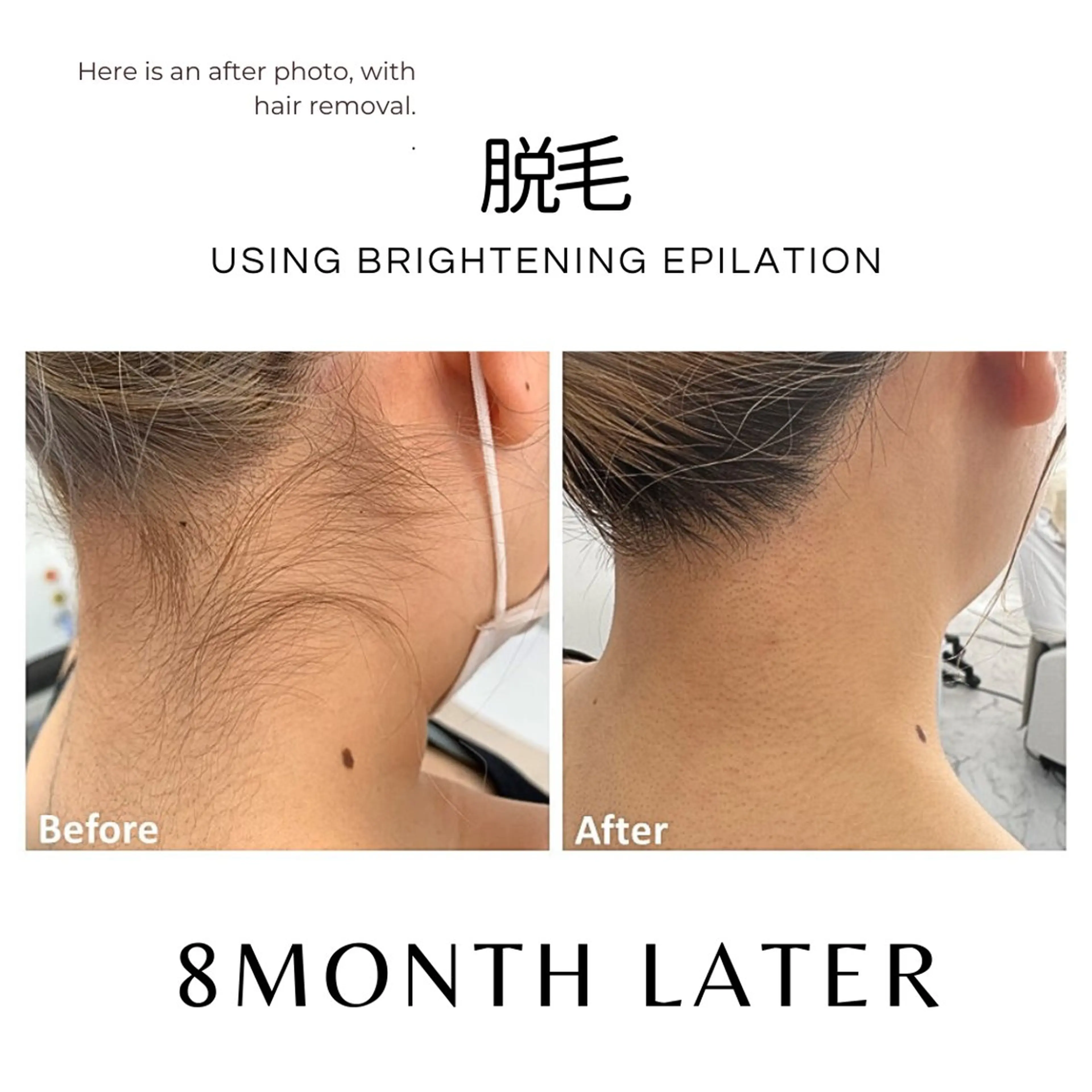 脱毛 脱毛サロンHUGME 光フォトフェイシャルのエステ・リラクイメージ