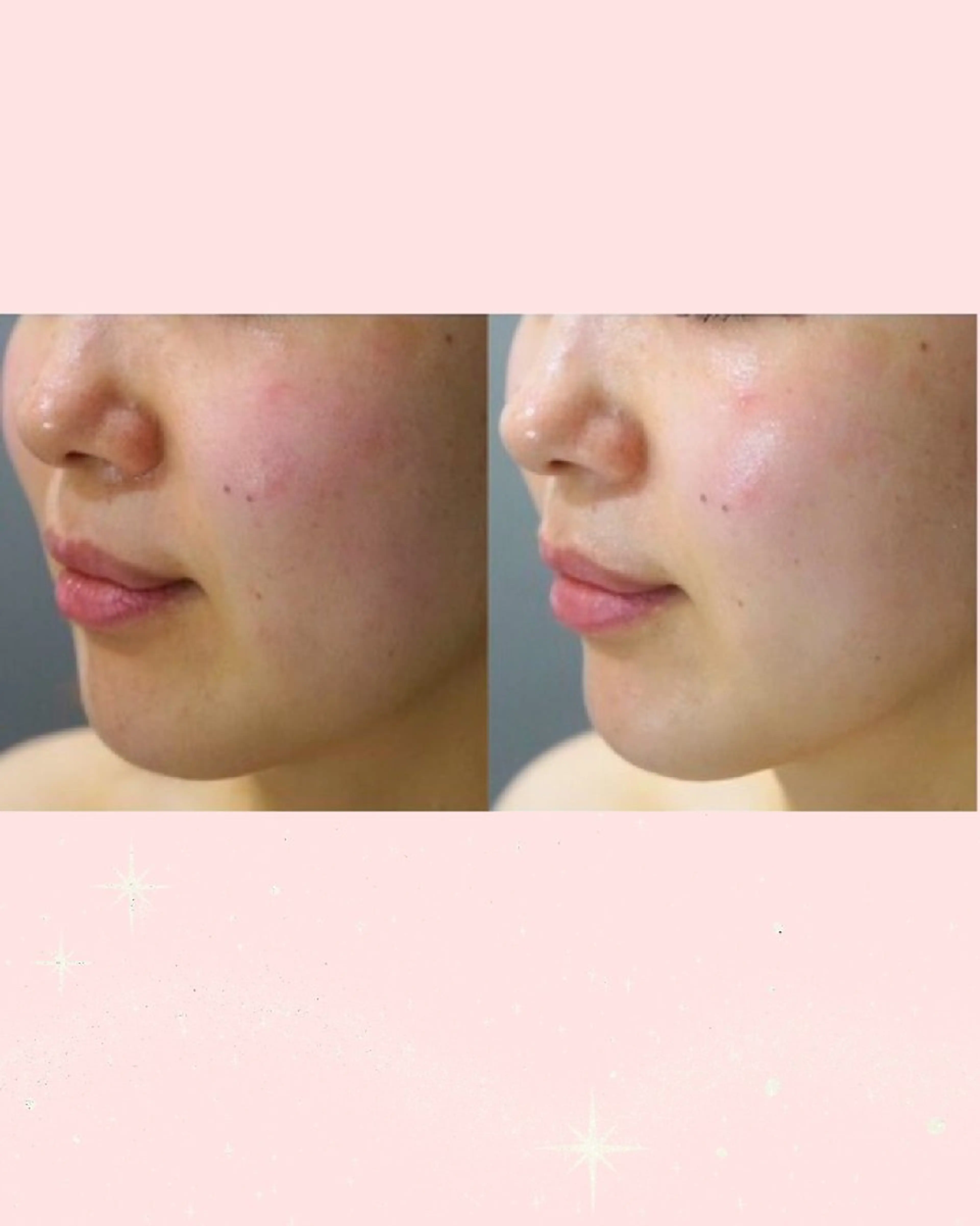 【お悩み：くすみ・元気ない肌】透明感爆発♪うるちゅる白玉美肌ケア　60分（初回カウンセリング・着替え込み120分）の写真