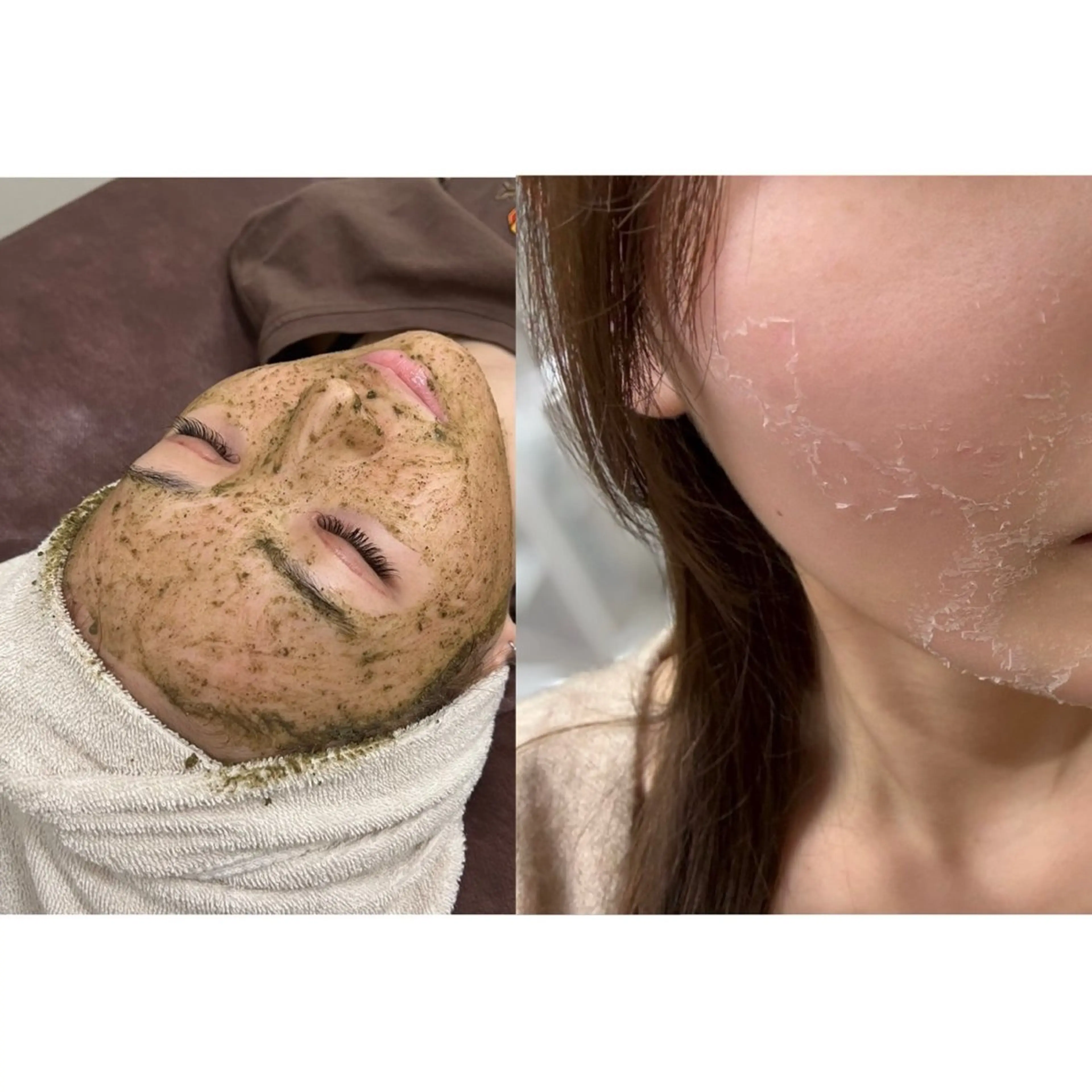 【劇的美肌改革×圧倒的変化】ローズドメーラ剥離ハーブピーリングの写真