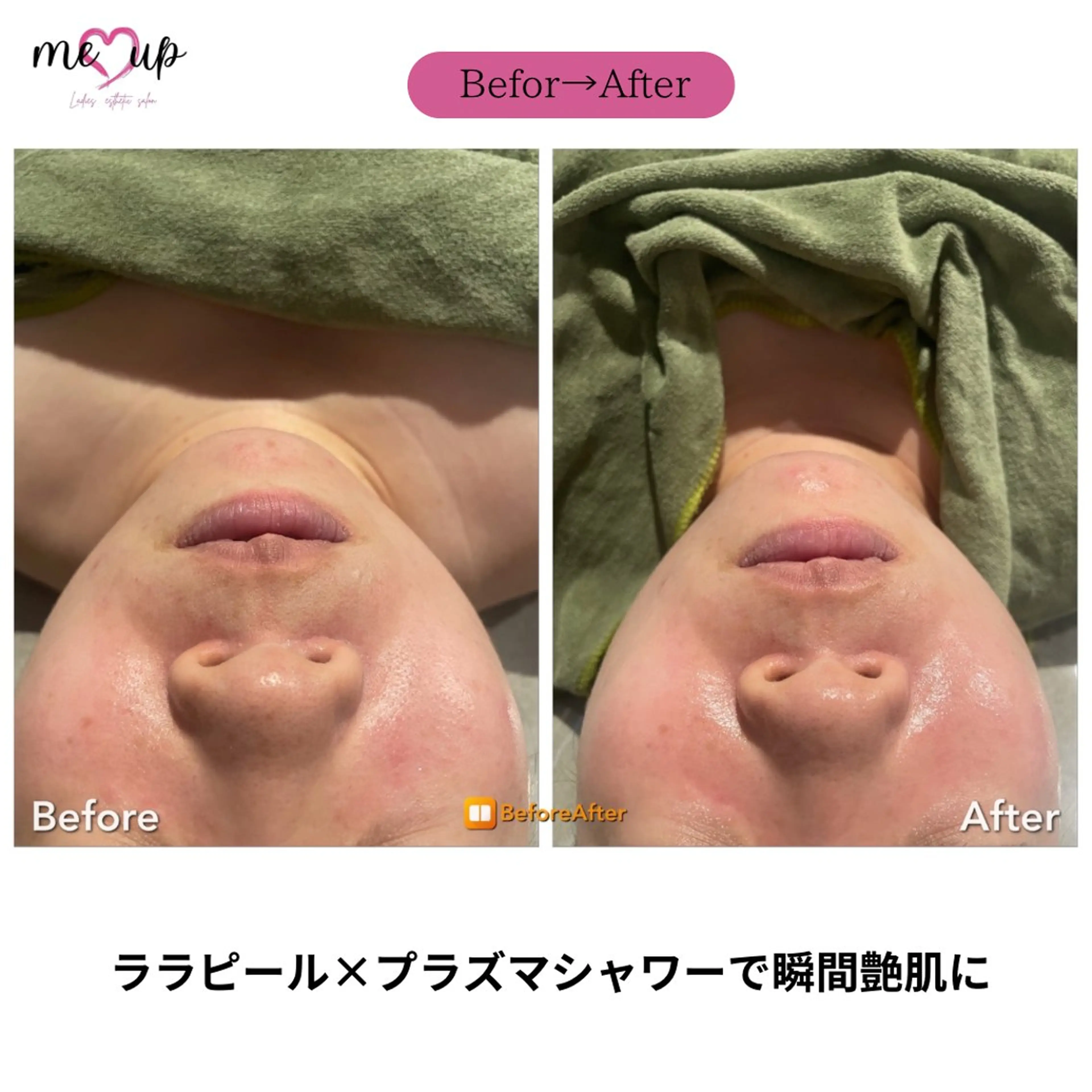 エステ Meupニキビ専門店 背中/ハーブ/肌管理のその他イメージ