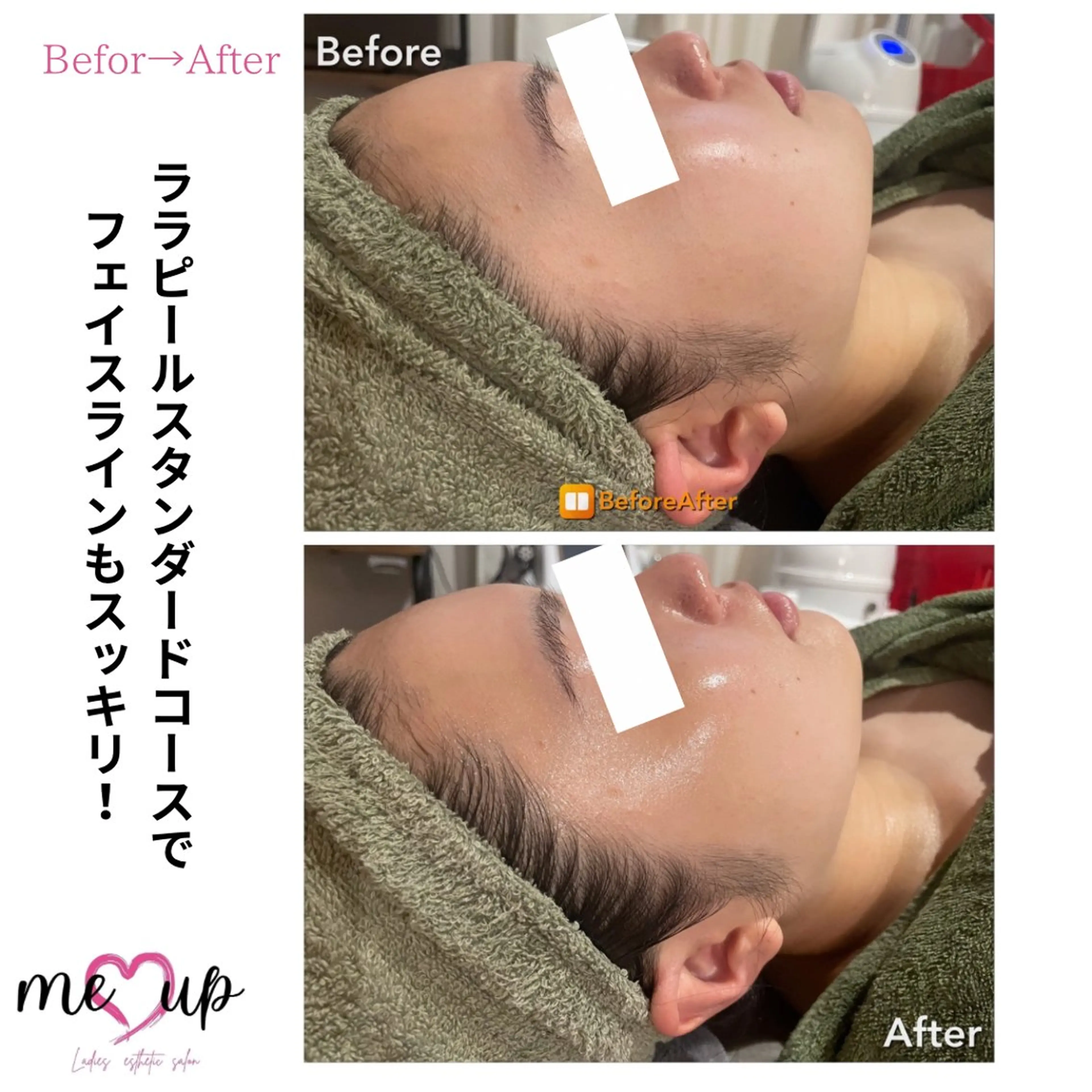 エステ Meupニキビ専門店 背中/ハーブ/肌管理のその他イメージ