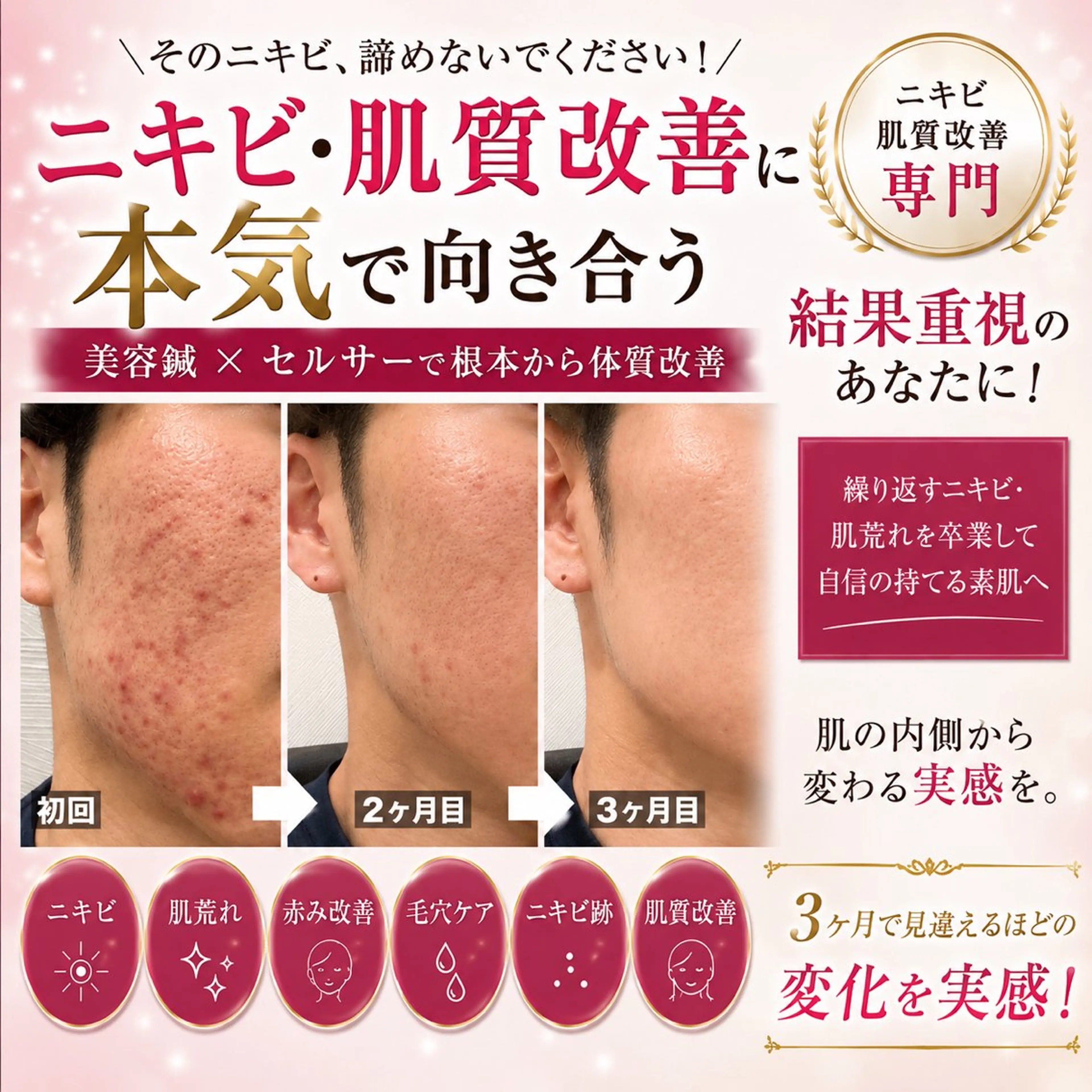 メンズ エステ リラク 肌質改善×美容鍼 ゆいのエステ・リラクイメージ