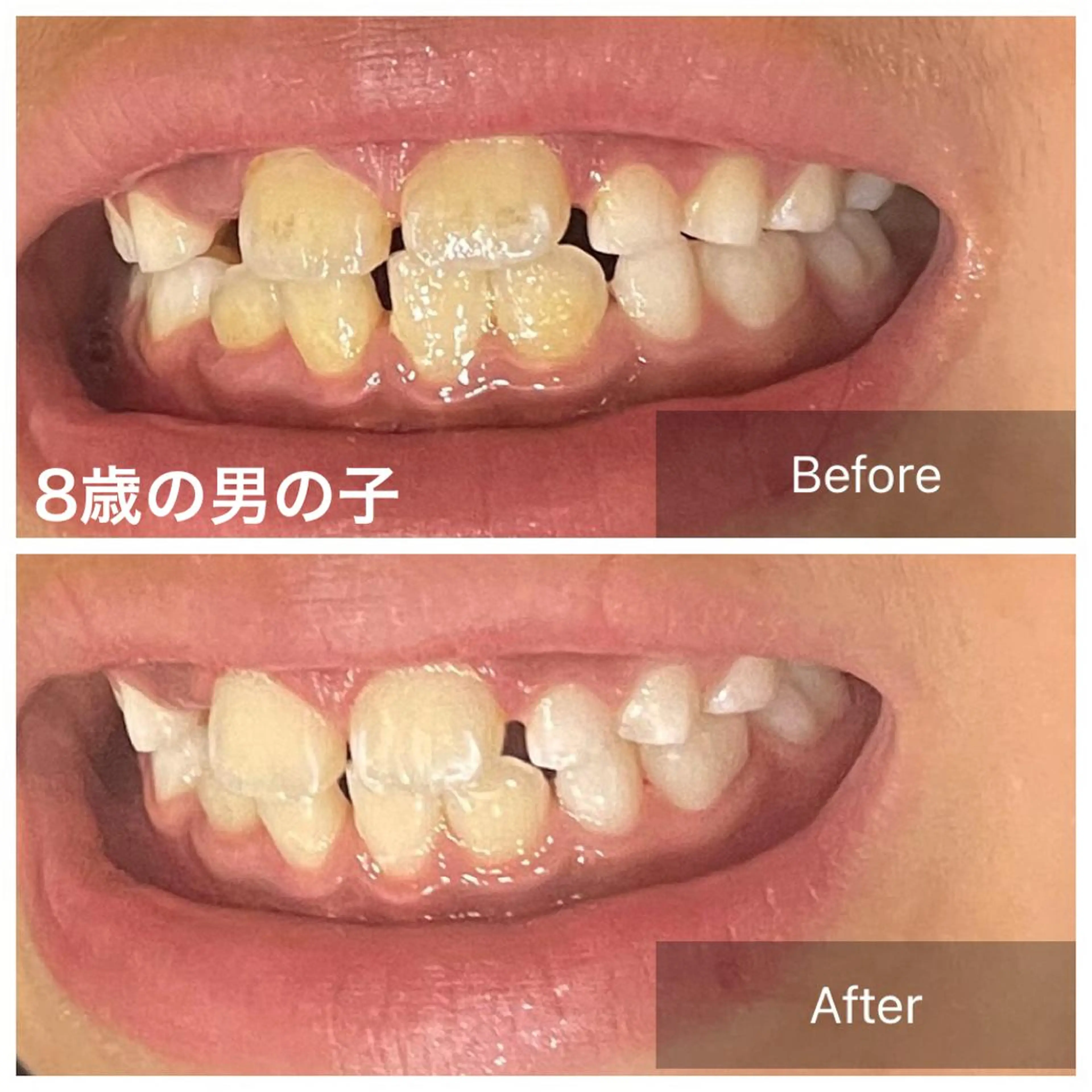 セルフホワイトニング　15分✖️2回照射　初回限定価格💕の写真