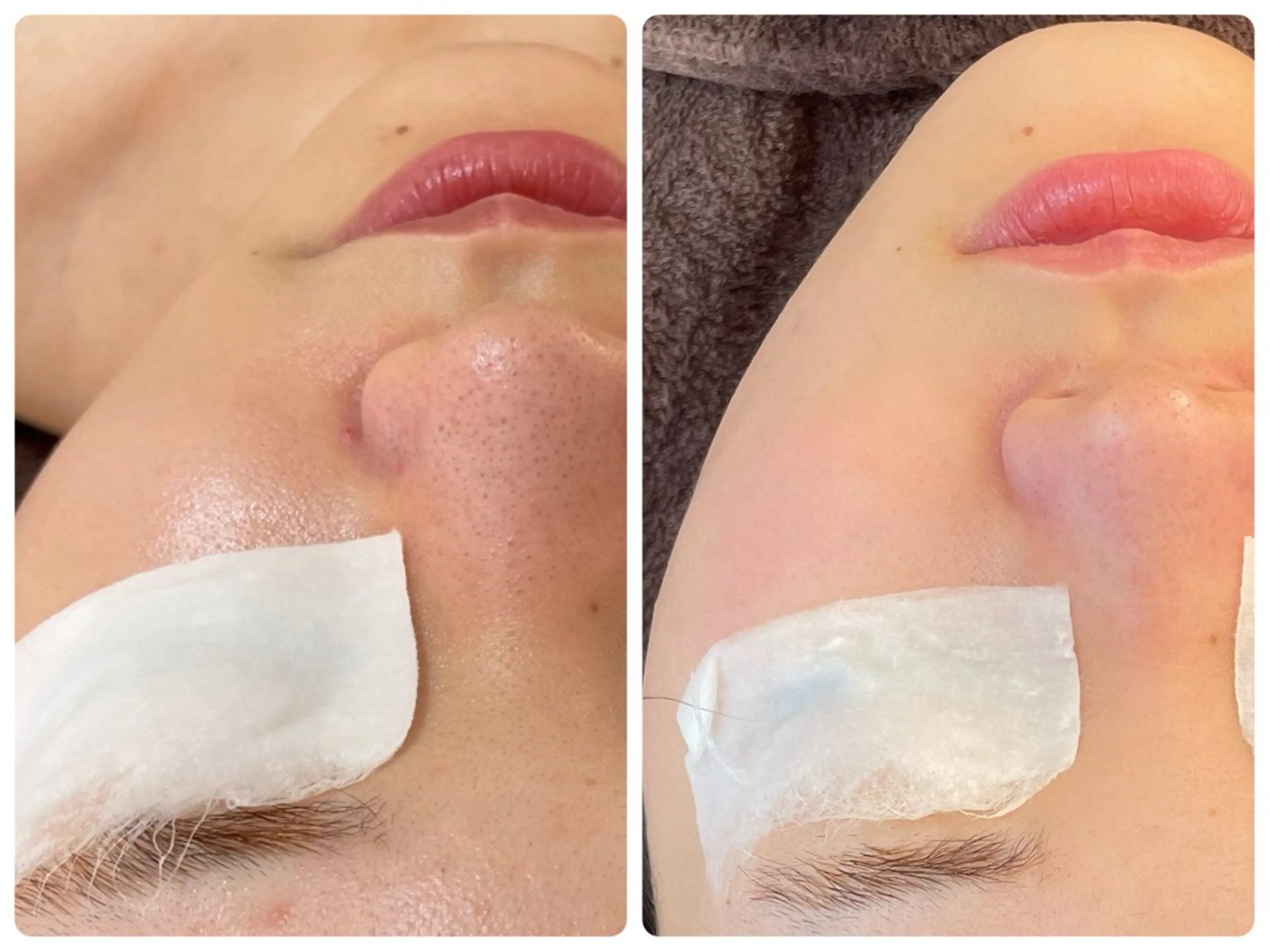 “ハイドロ、洗浄毛穴モニター募集中”黒ずみ/テカリ/つまり/開き毛穴/シミの写真