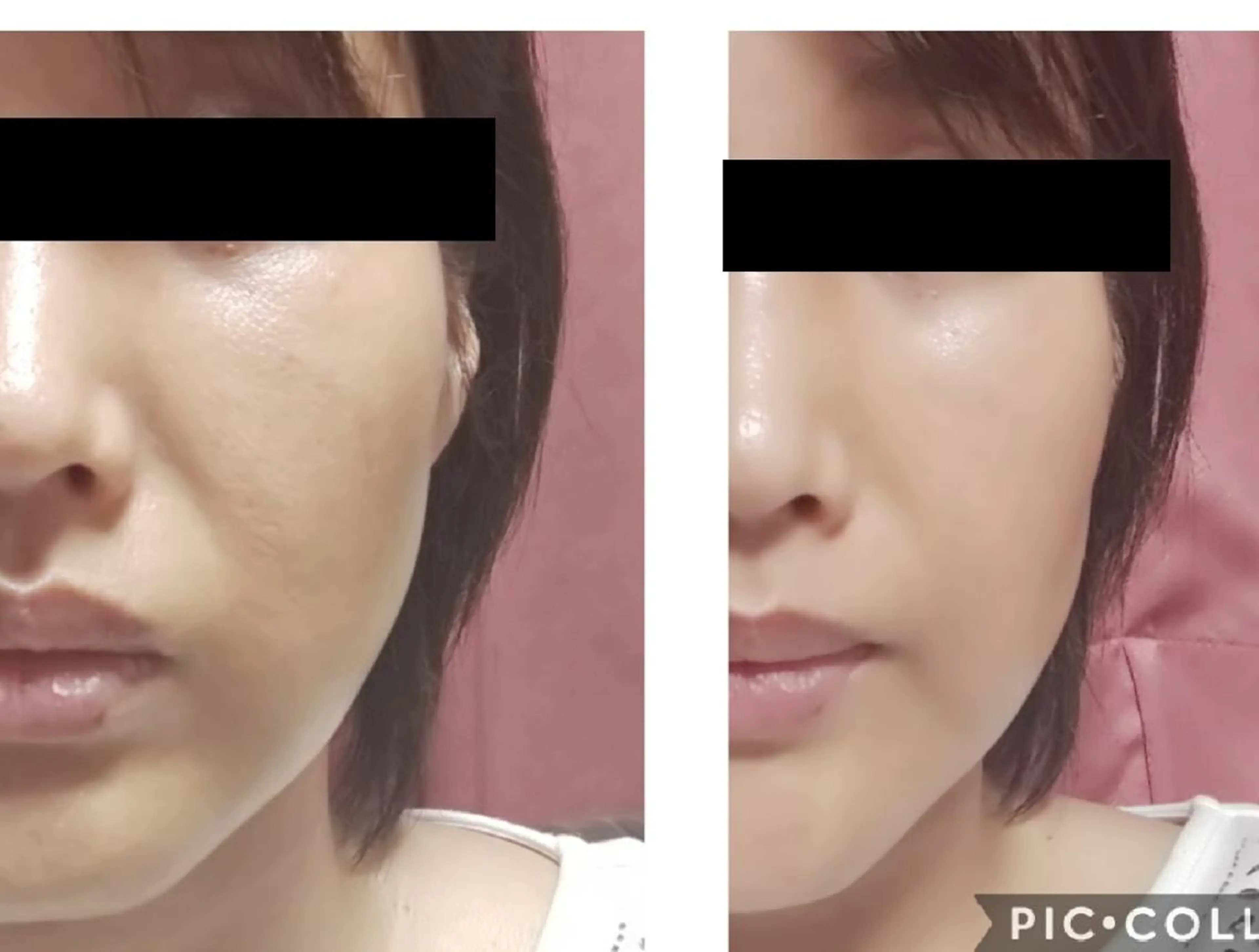 パイラナイトフェイシャル✨🍀リフトアップしたい方🍀艶、ハリがほしい方🍀ほうれい線改善したい方などの写真