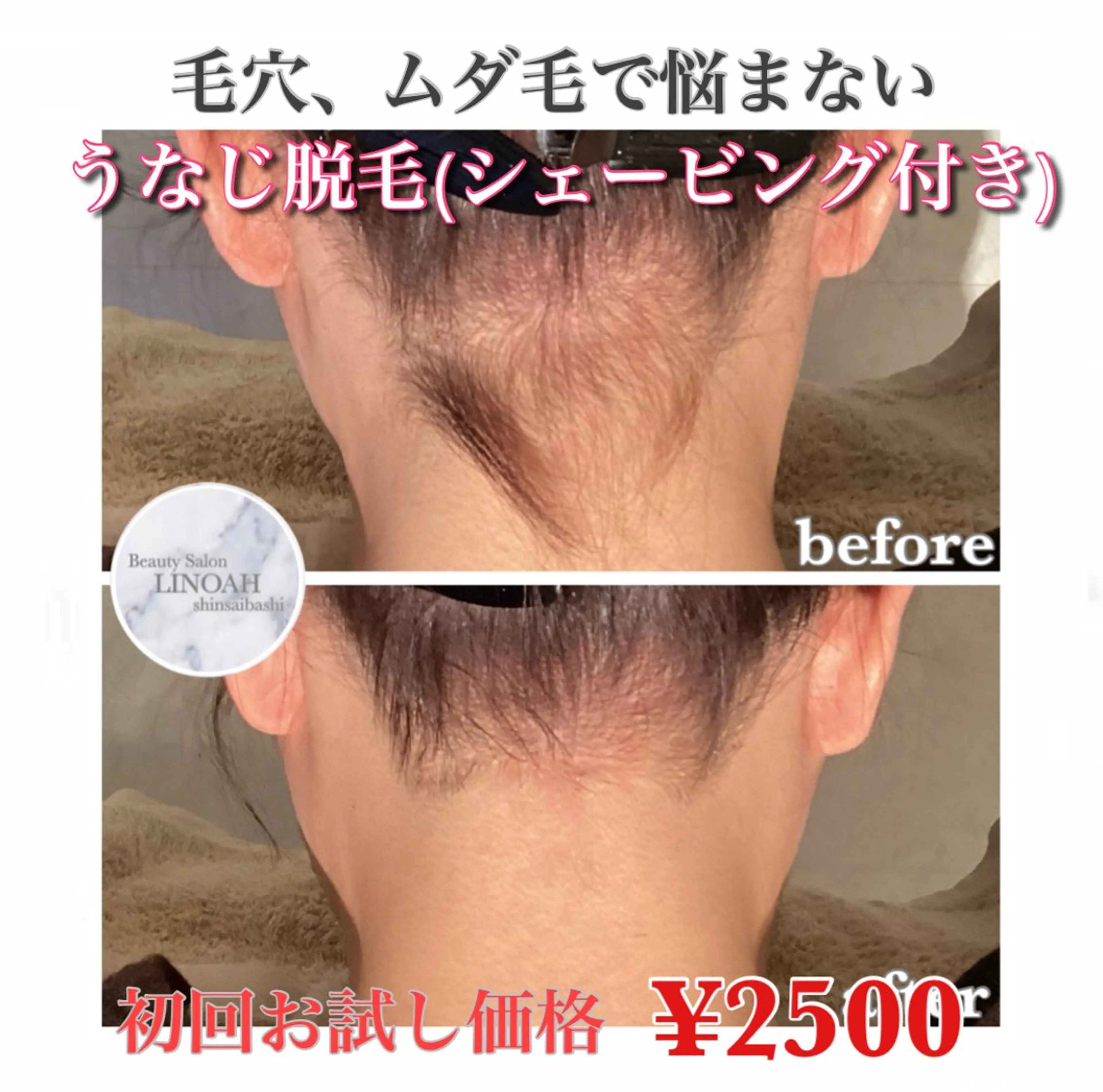 🉐【毛穴/ムダ毛改善】うなじ脱毛 （シェービング付き） ¥4180 → ¥2500の写真