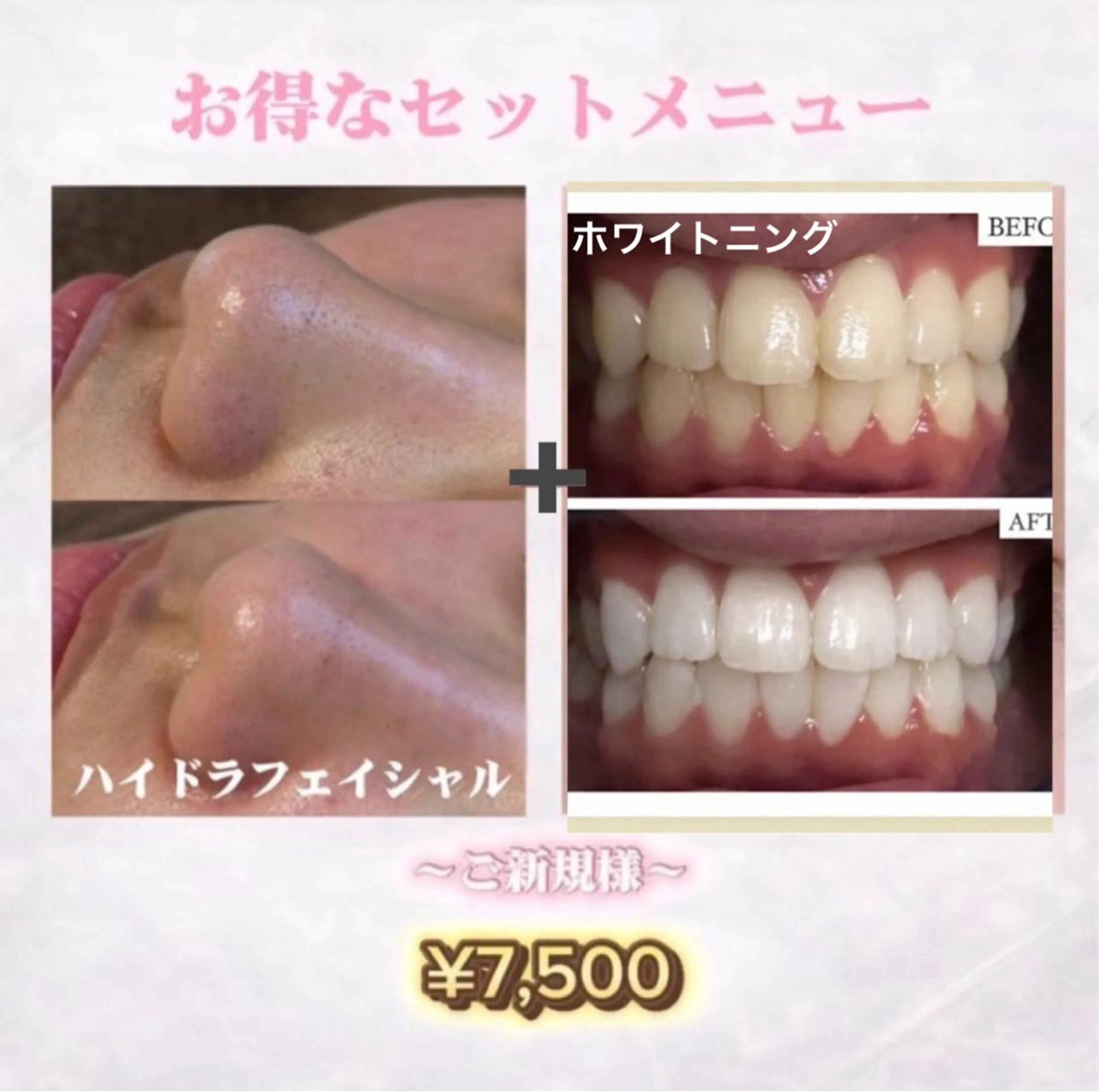 【🦋時短同時垢抜け お肌×歯set】一石二鳥の最強セット🕊️ハイドラフェイシャル×ホワイトニングの写真