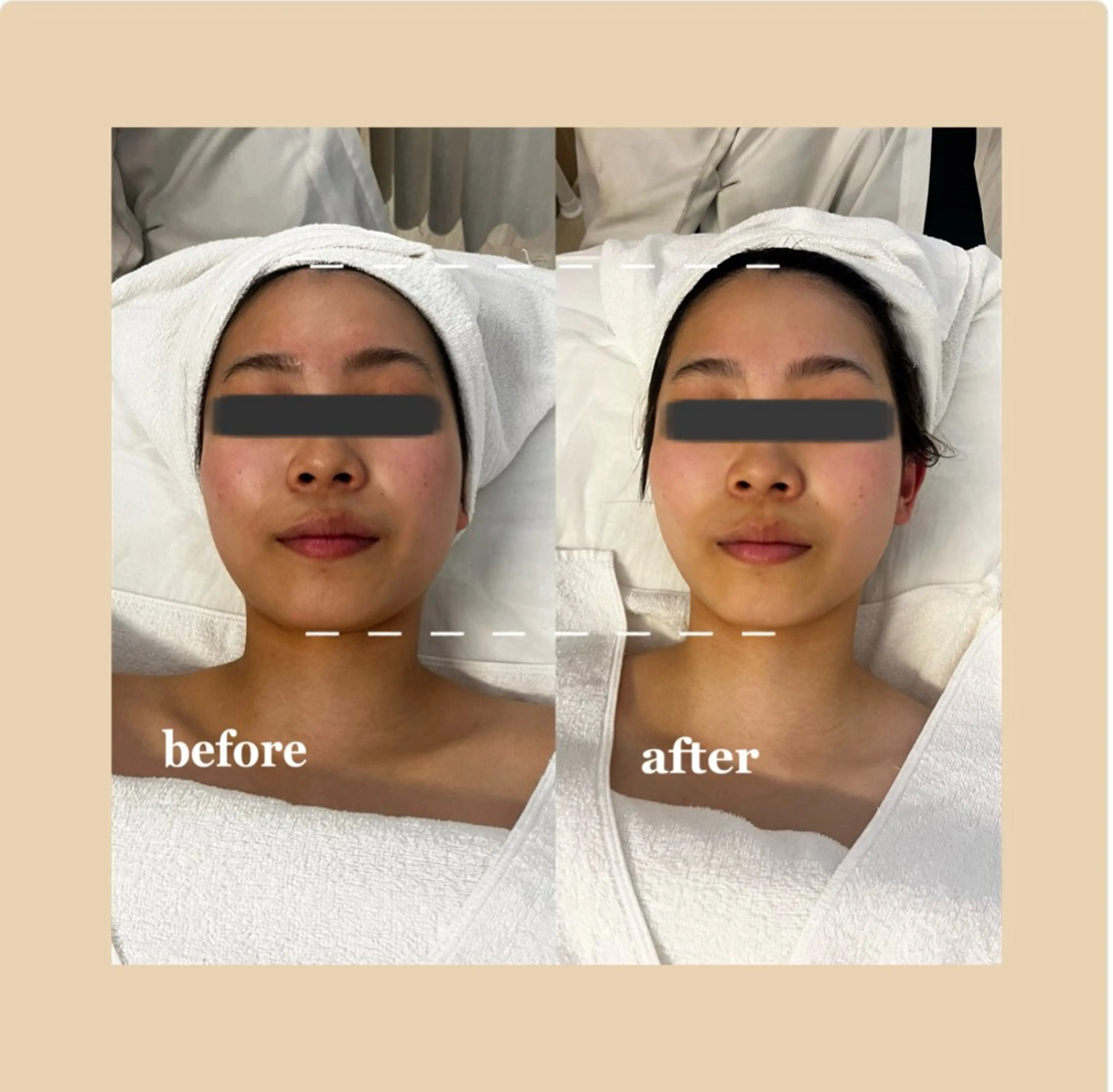 【3月限定メニュー❕】小顔効果＆トーンアップあり‼︎フェイシャルマッサージ💆🏻‍♀️🌟＋お肌診断付きの写真