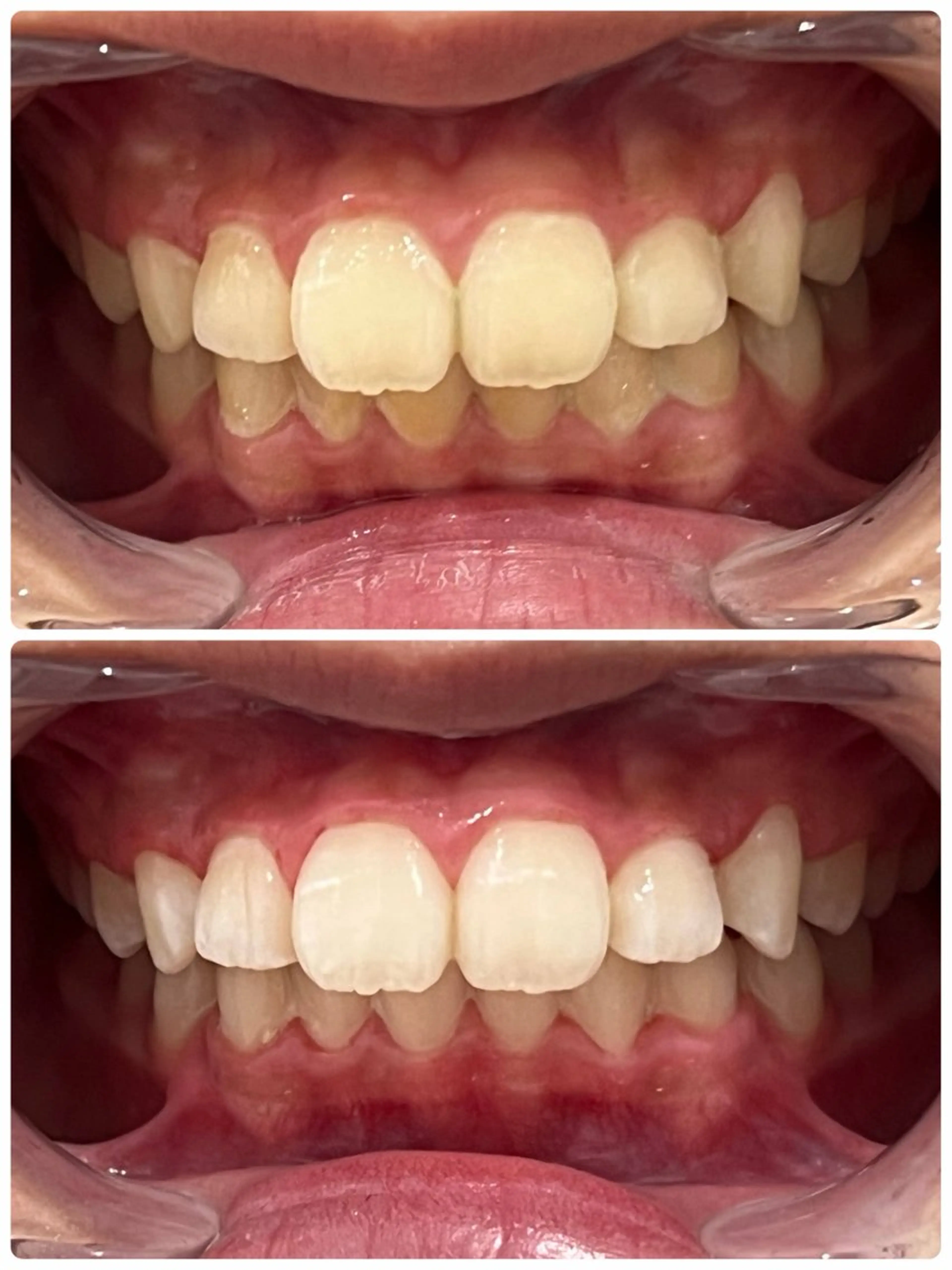 【ご新規】歯のセルフホワイトニング🦷サポートあり！15分2回照射で満足な白さに！の写真