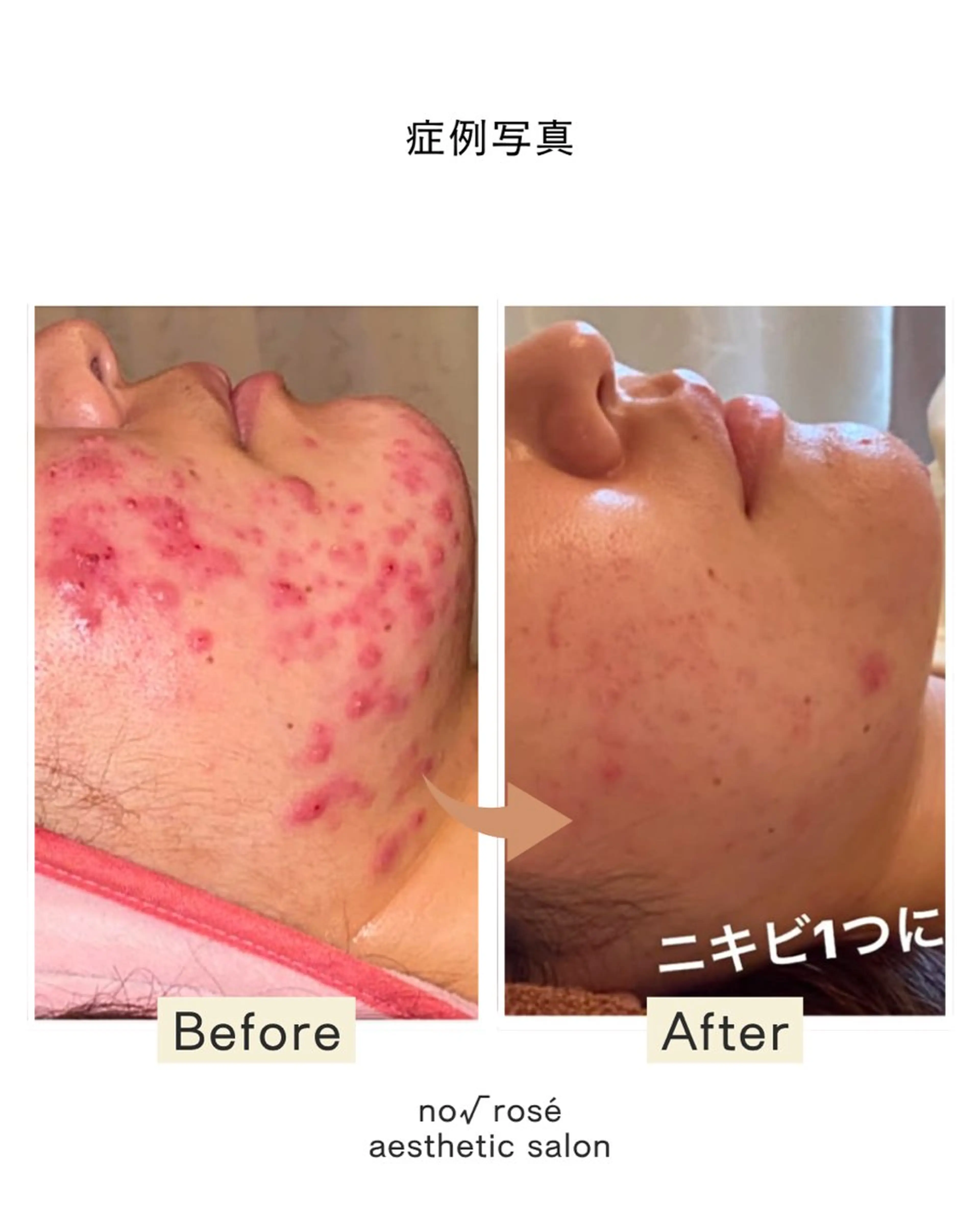 【もう辛いとは言わせない‼️】本気で悩んでいるなら当店人気No.1剥離ありハーブピーリング🌿治せないニキビは無いの写真