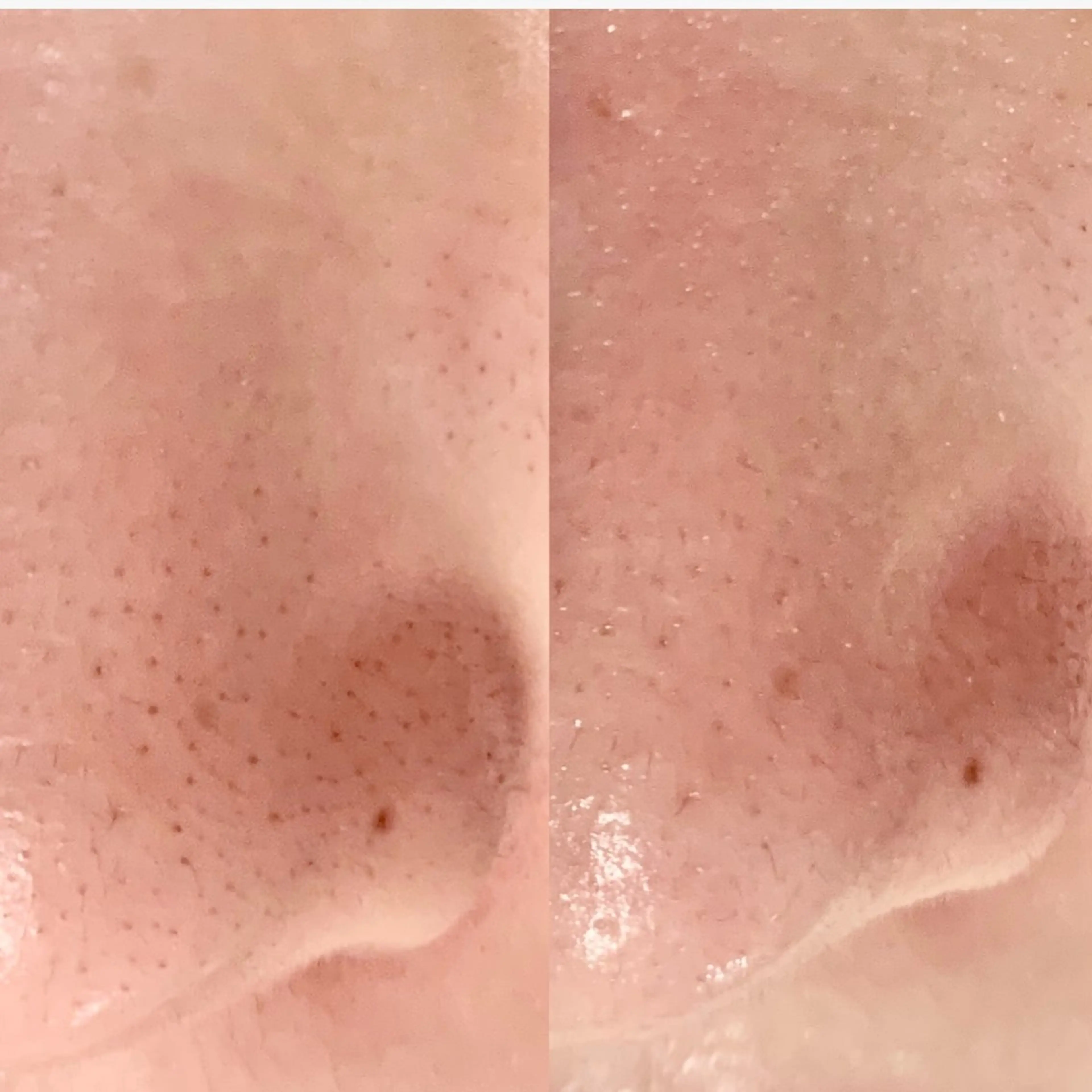 ️🫧ハイドロフェイシャル️🫧水素の力で毛穴をしっかり洗浄❣️毛穴の黒ずみ除去/角質除去の写真