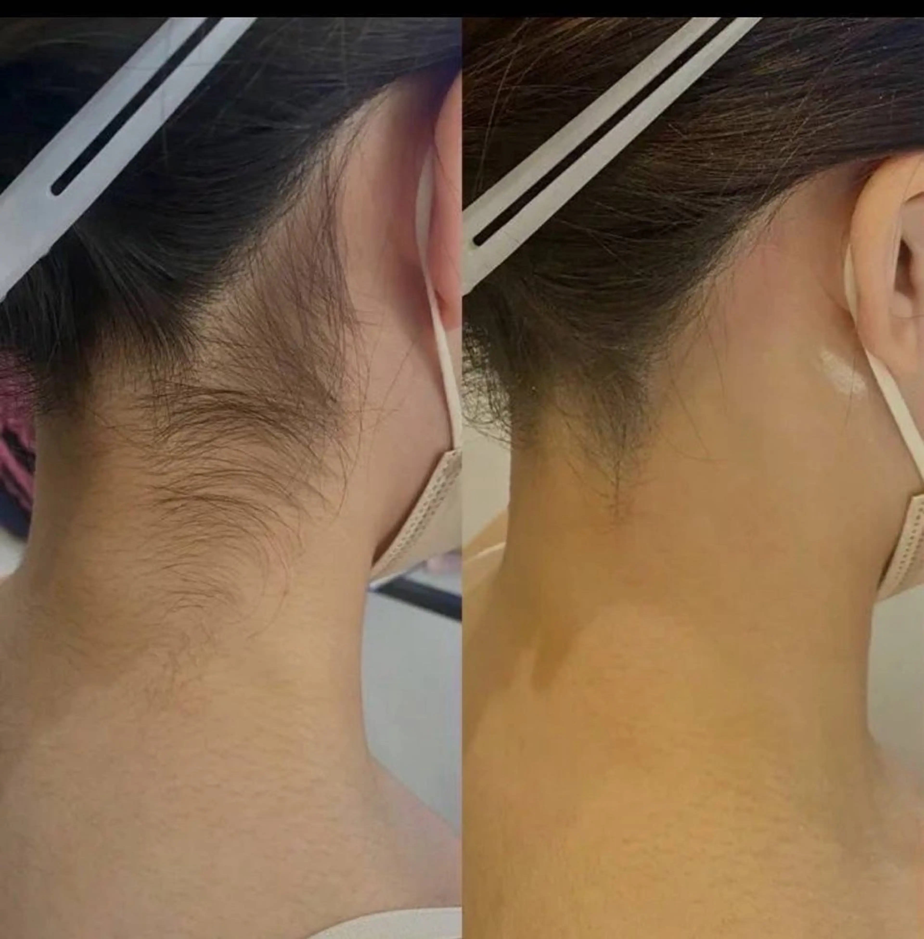 《襟足脱毛》うなじ美人になりましょう✨の写真