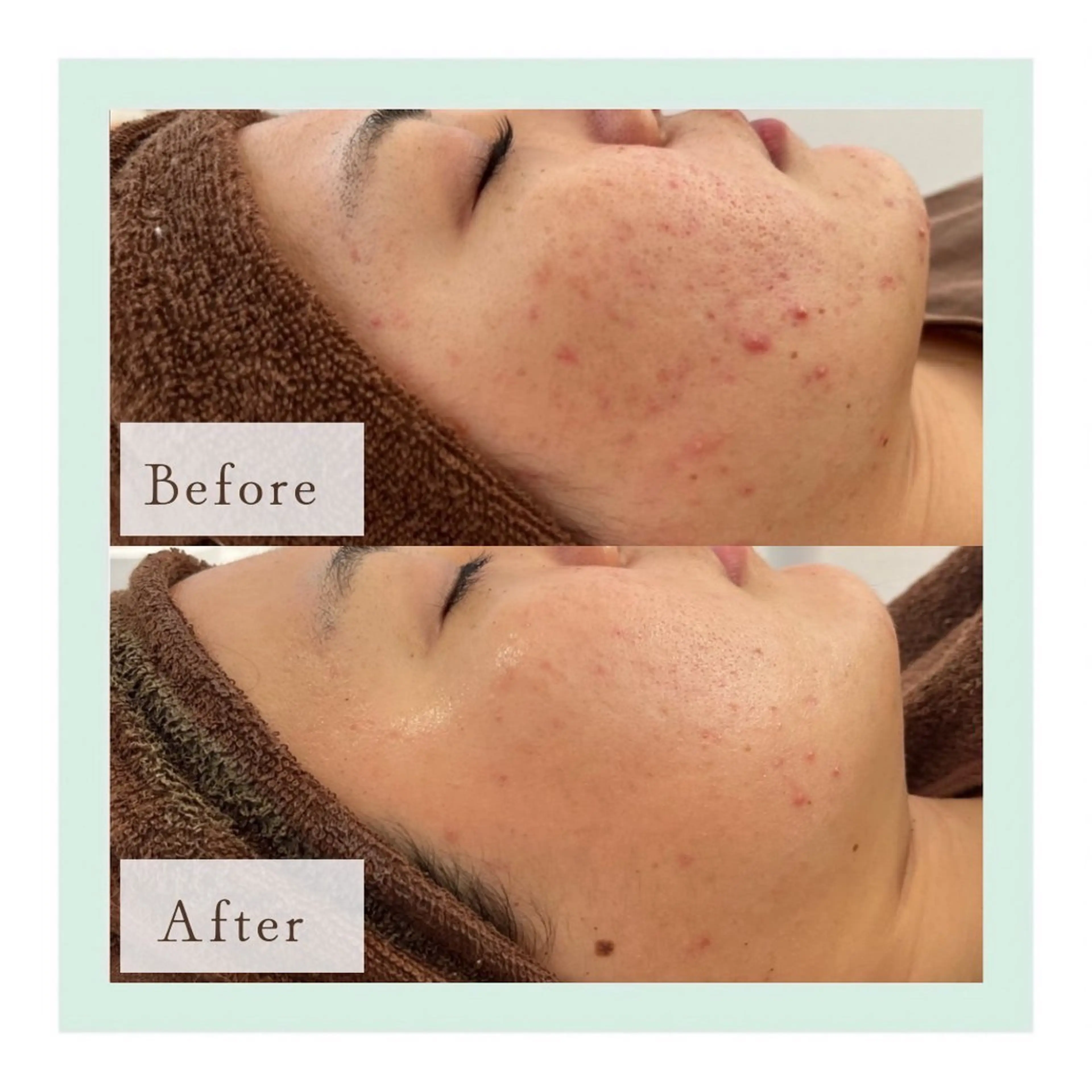 【REVI シミケア】の写真