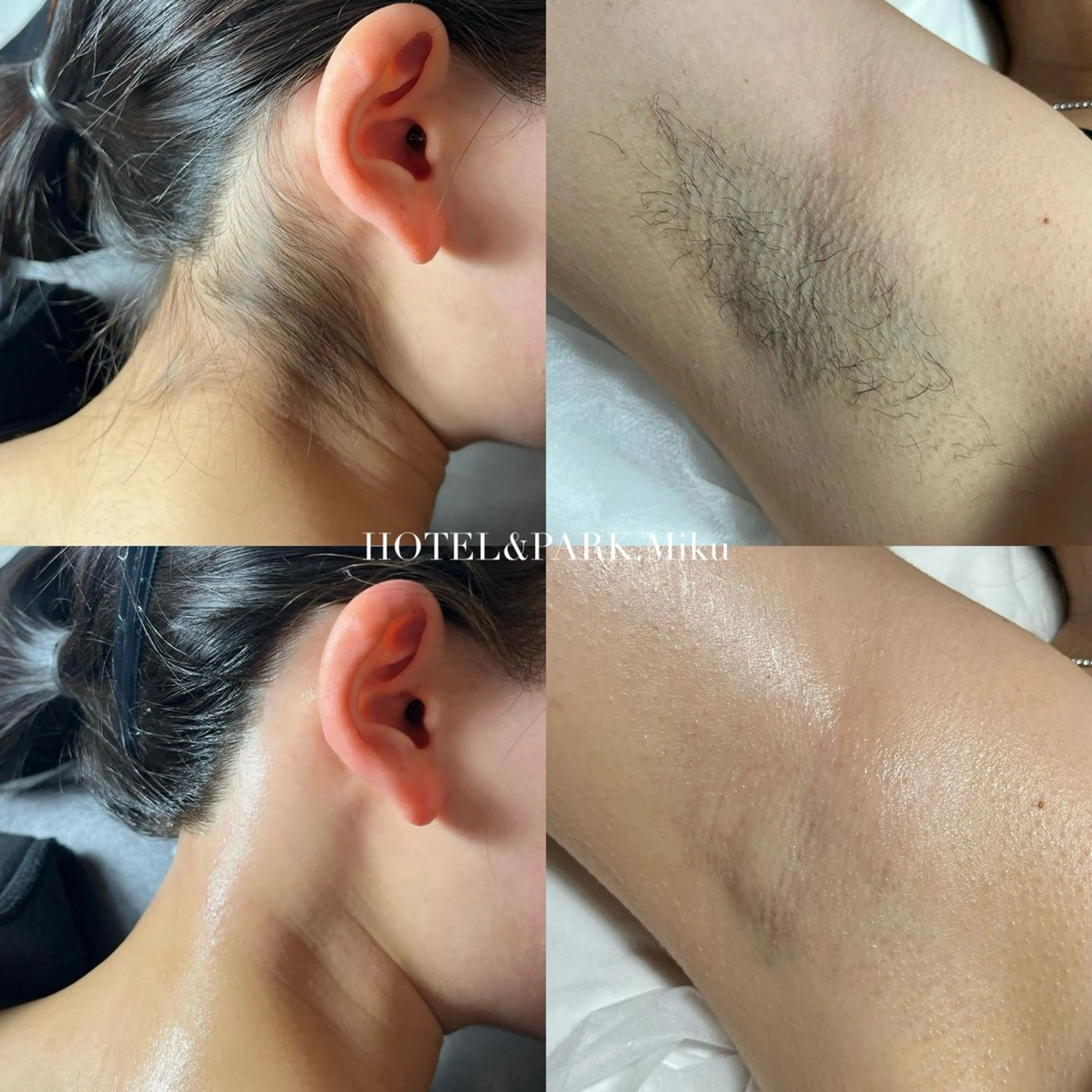 HOTEL&PARK . ワックス脱毛のエステ・リラクイメージ