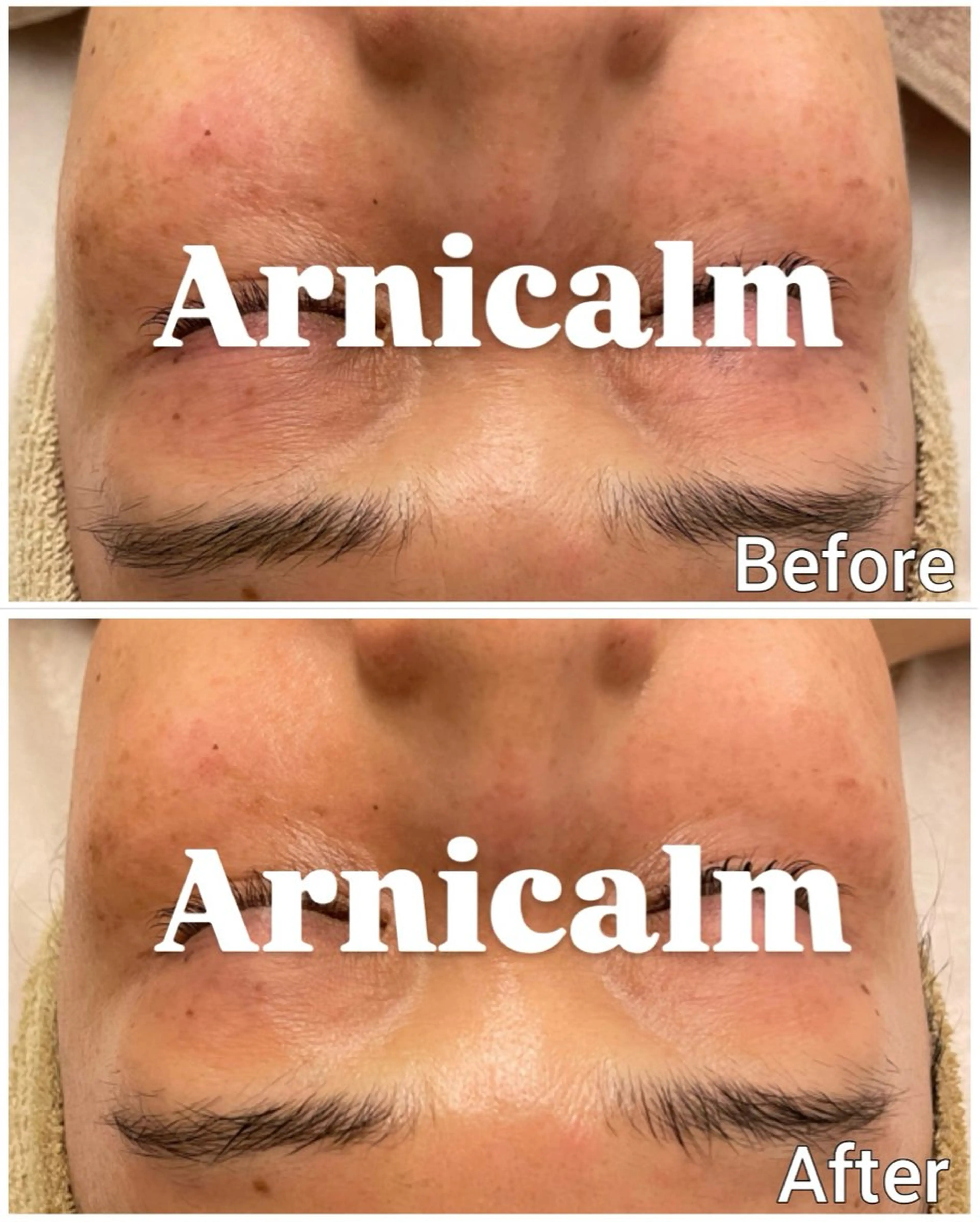 ハーブピーリング 肌再生ピーリング/のエステ・リラクイメージ