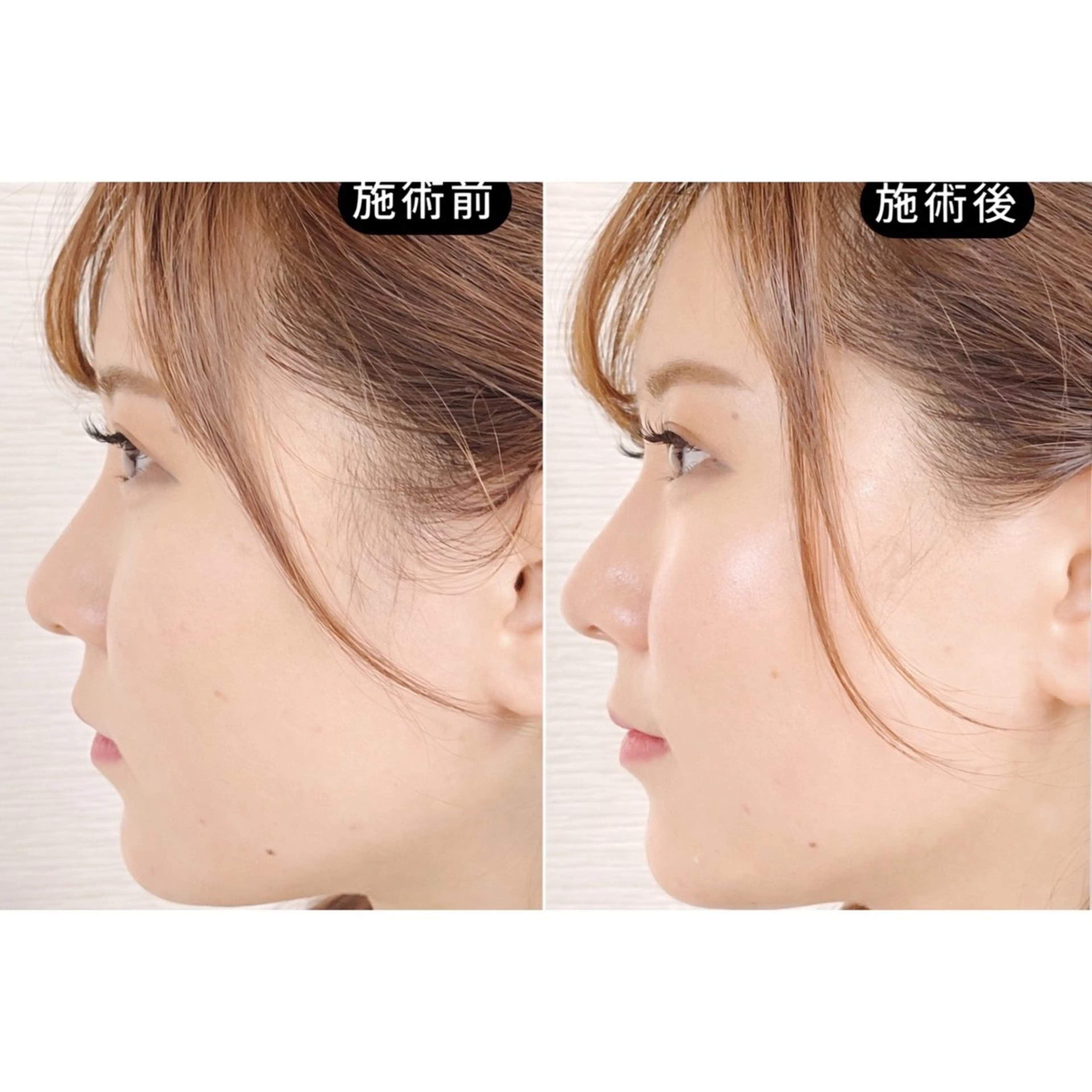 【SALE】二重アゴ・フェイスライン・左右差ケア 整体×EMS×美容鍼の写真