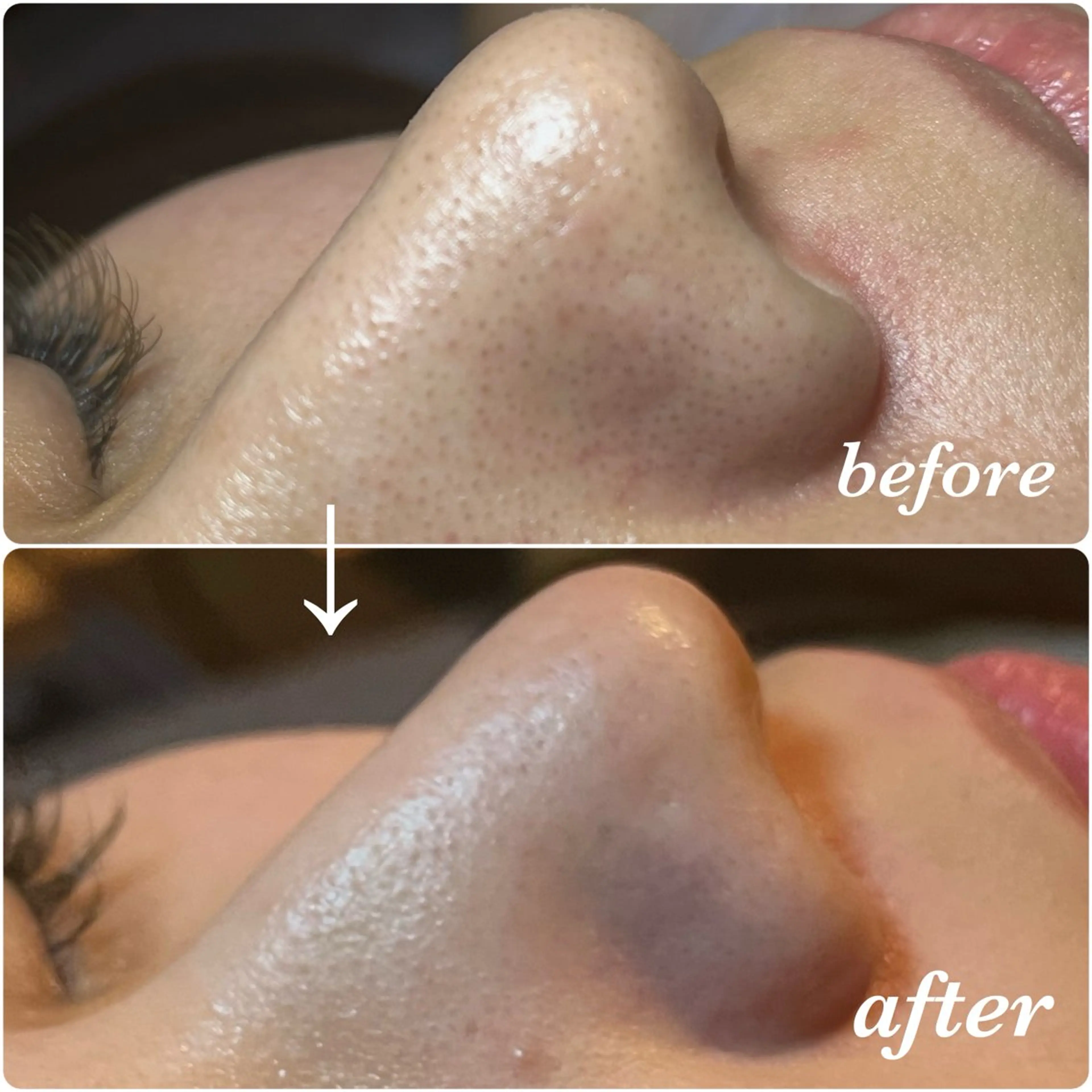 《フェイシャル》毛穴ケアコースの写真