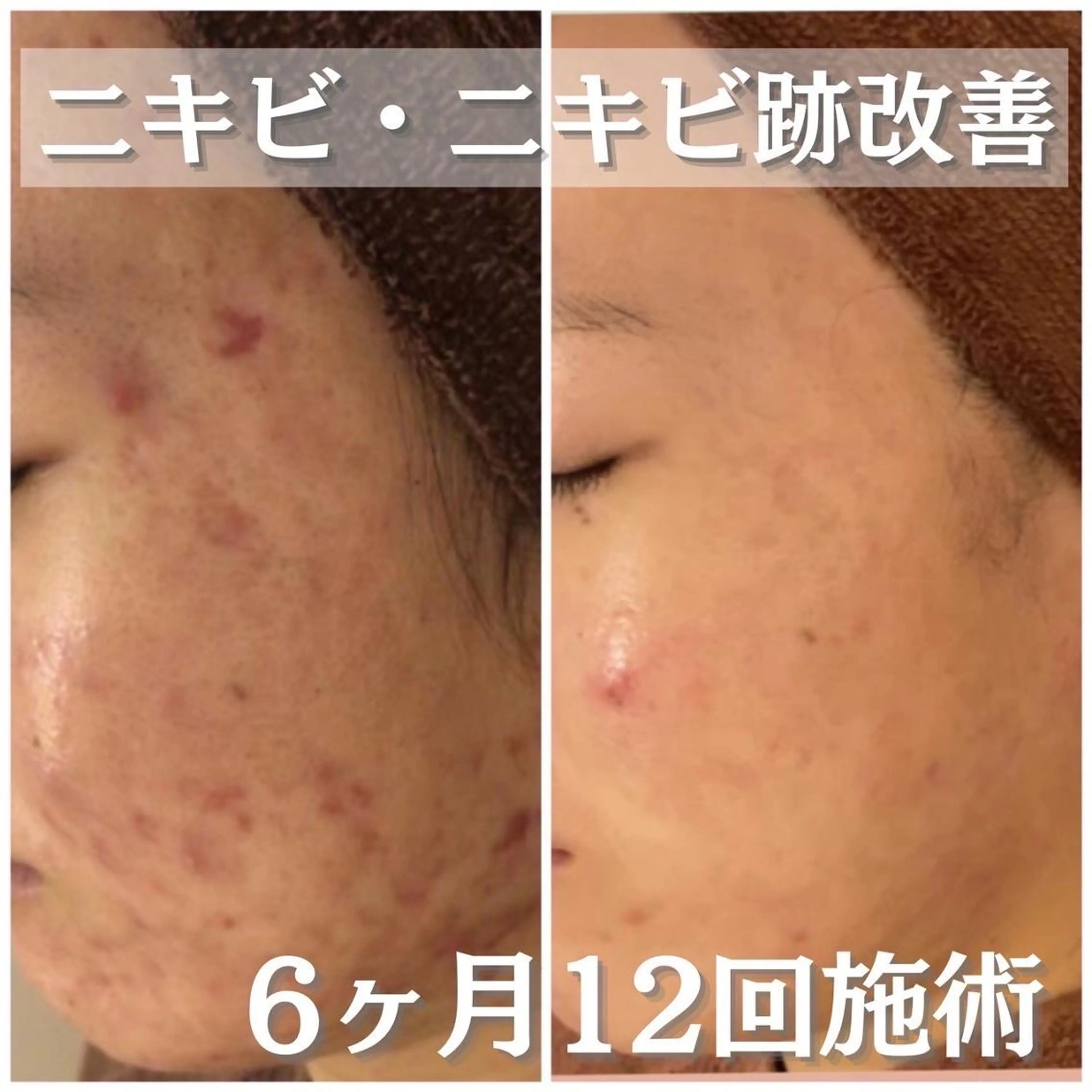 3か月で肌革命👼 ニキビ専門店💫のエステ・リラクイメージ