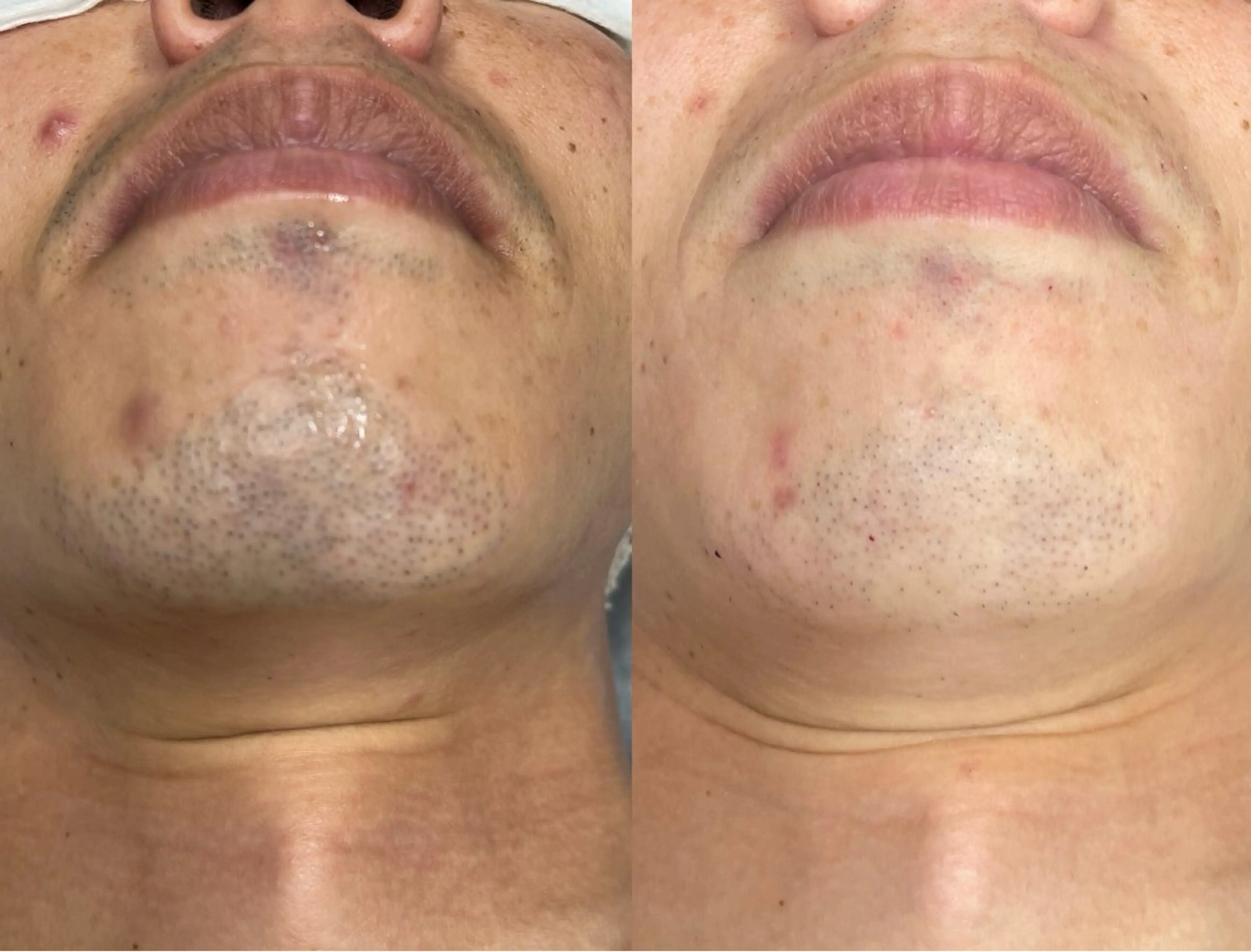 [半年後の再来価格🉐]ひげ脱毛🩵の写真