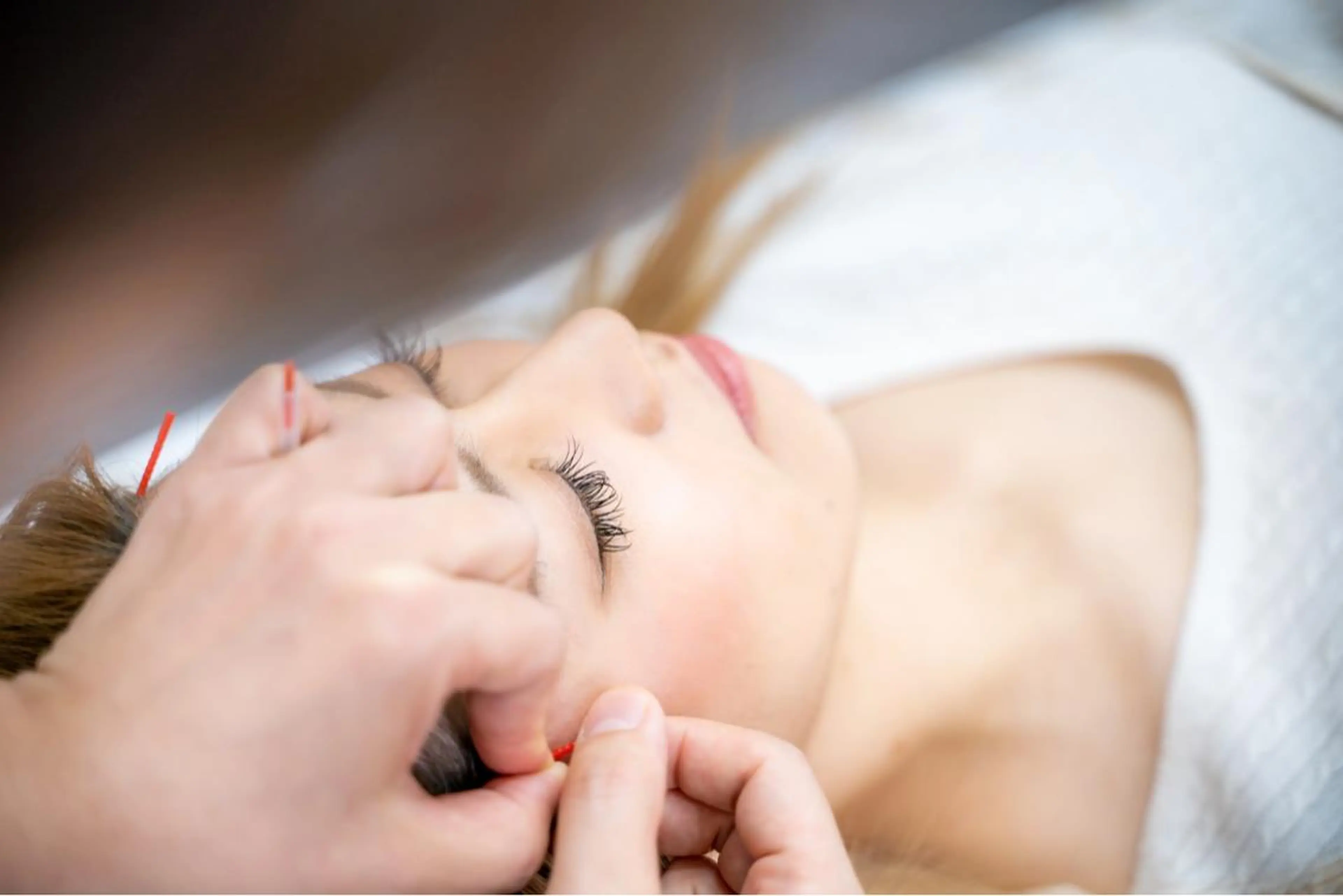 電気を使わない優しい美容鍼 + 小顔調整（初回）の写真