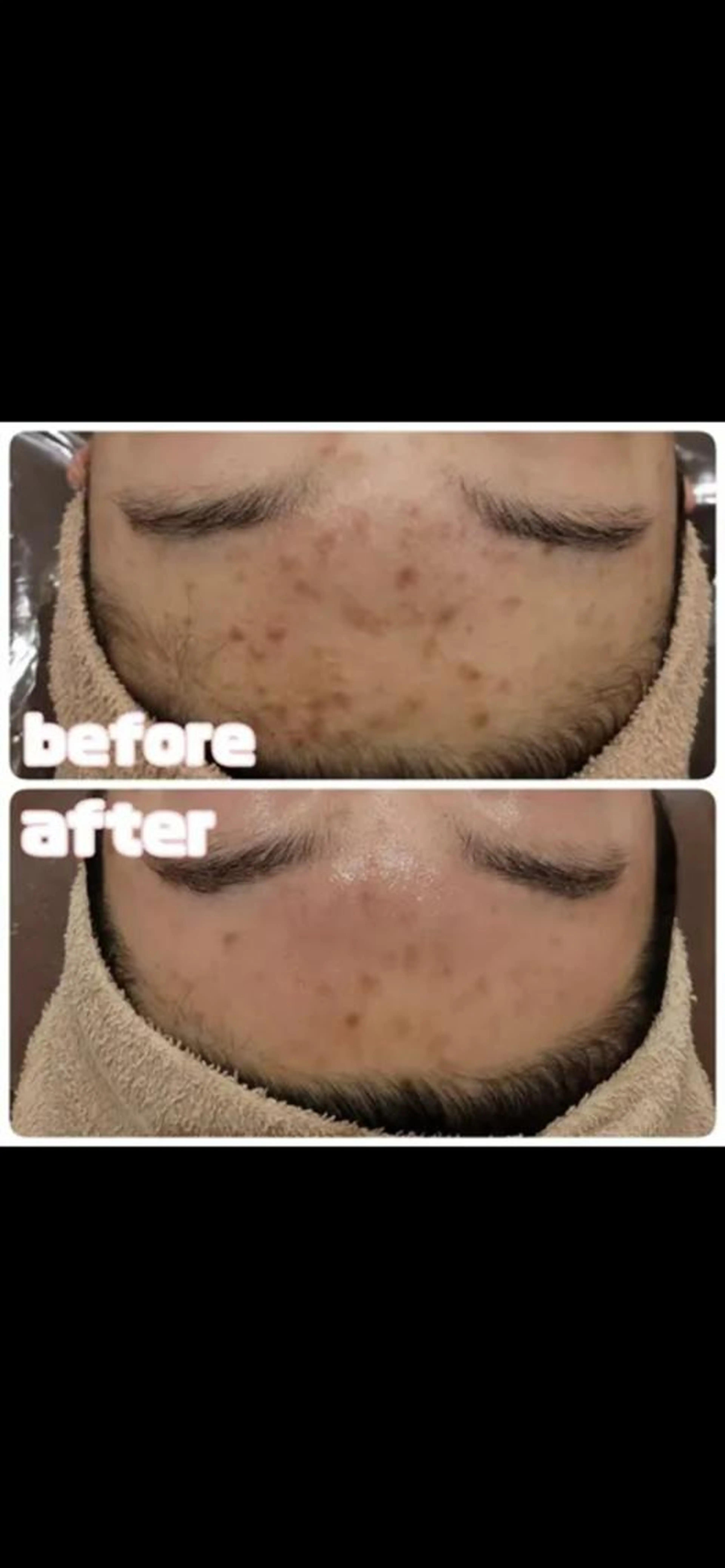 なおりにくいニキビに✨バディアガミネラルハーブ🌿効果重視の方へ✨\12000の写真