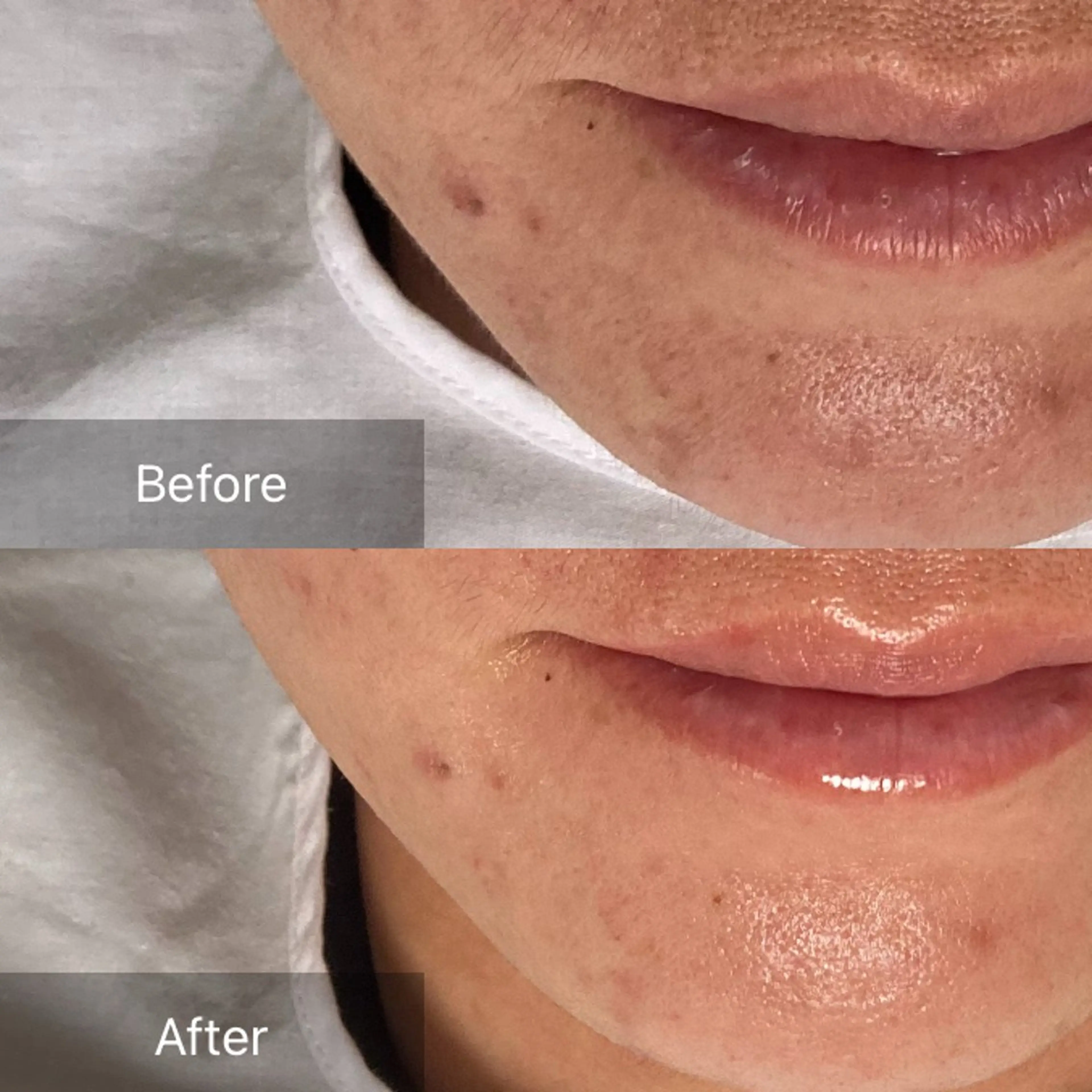 【吹出物. 毛穴悩み】オールハンドフェイシャルの写真