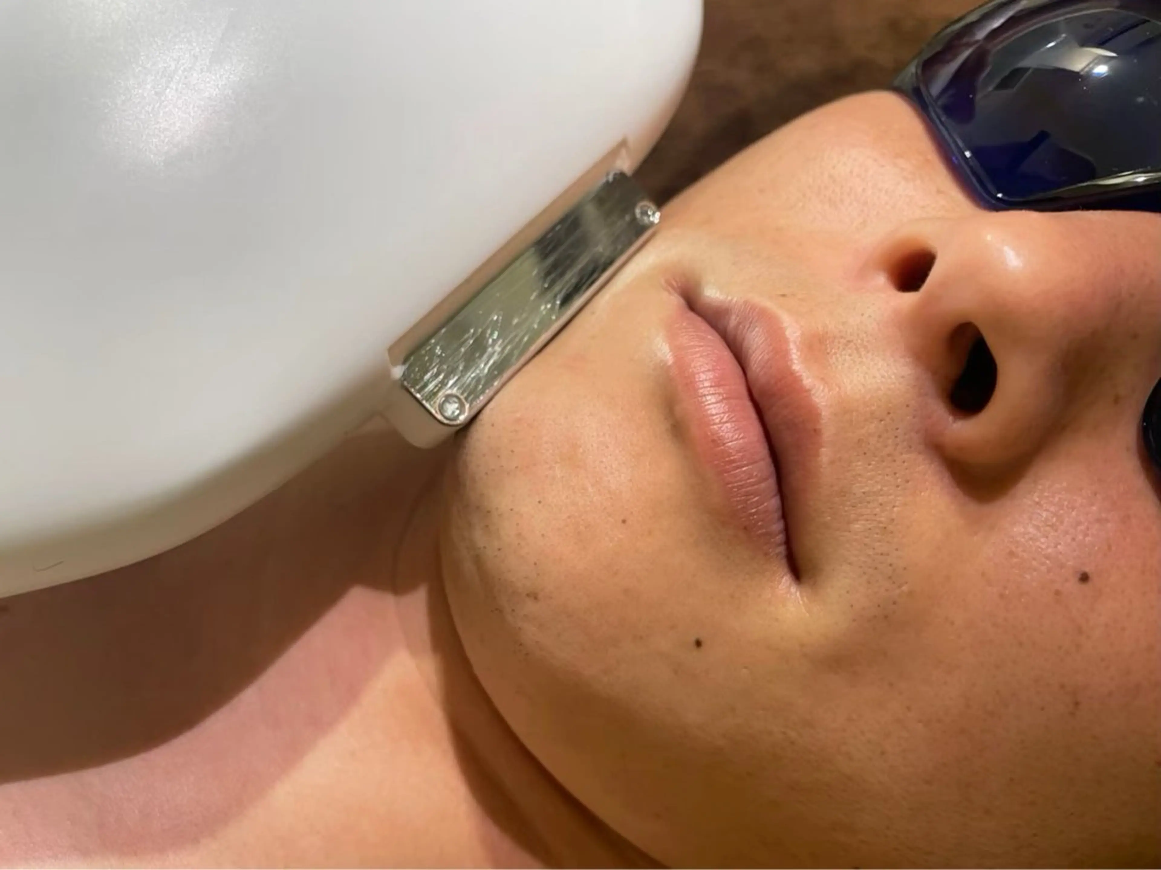 メンズヒゲ脱毛！　毎日のシェービングがなくなるだけでとっても楽に！青髭卒業しましょう！モテ肌スベスベにの写真