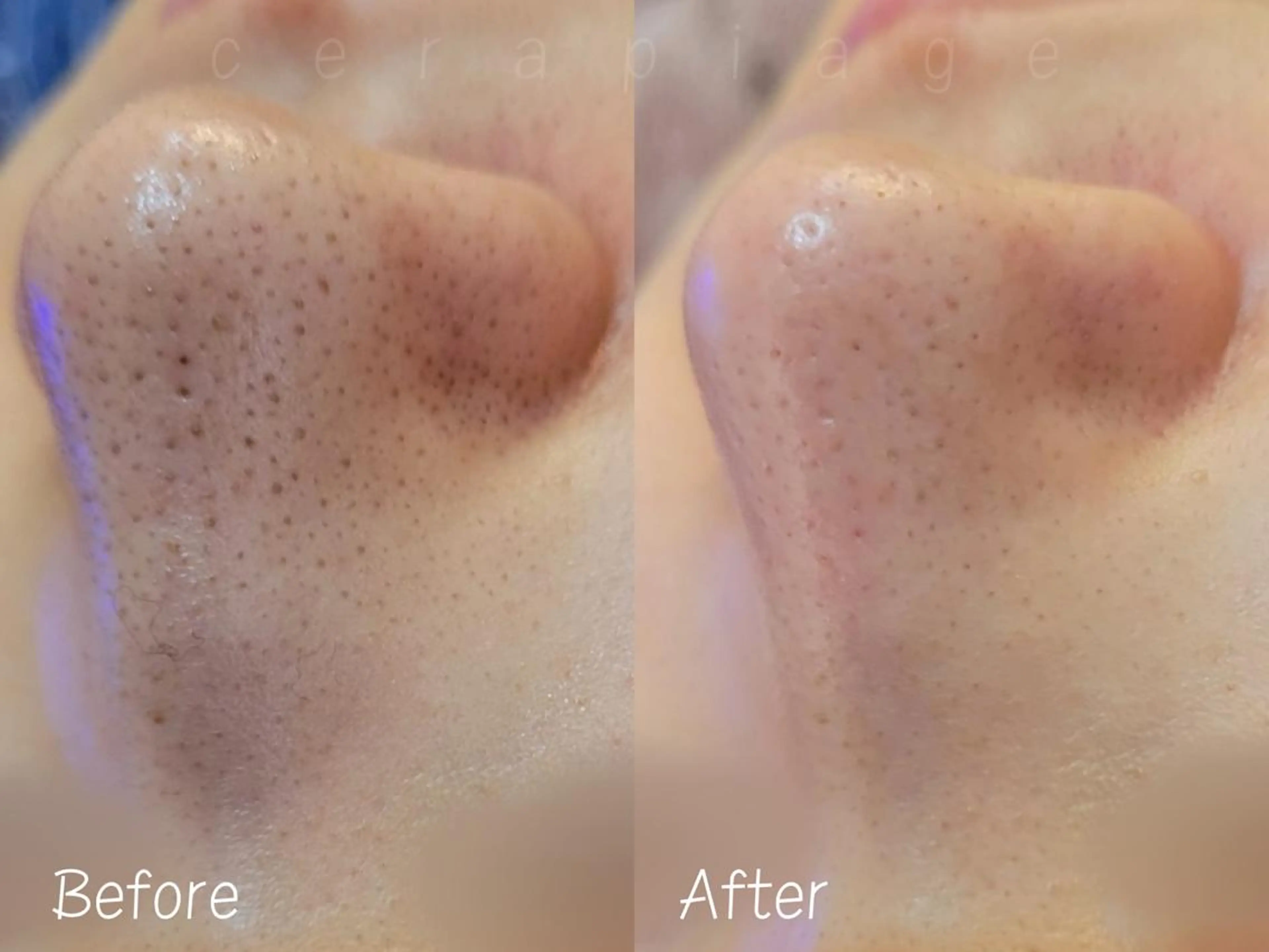 小顔/毛穴/肌質改善 💆セラピエージのエステ・リラクイメージ