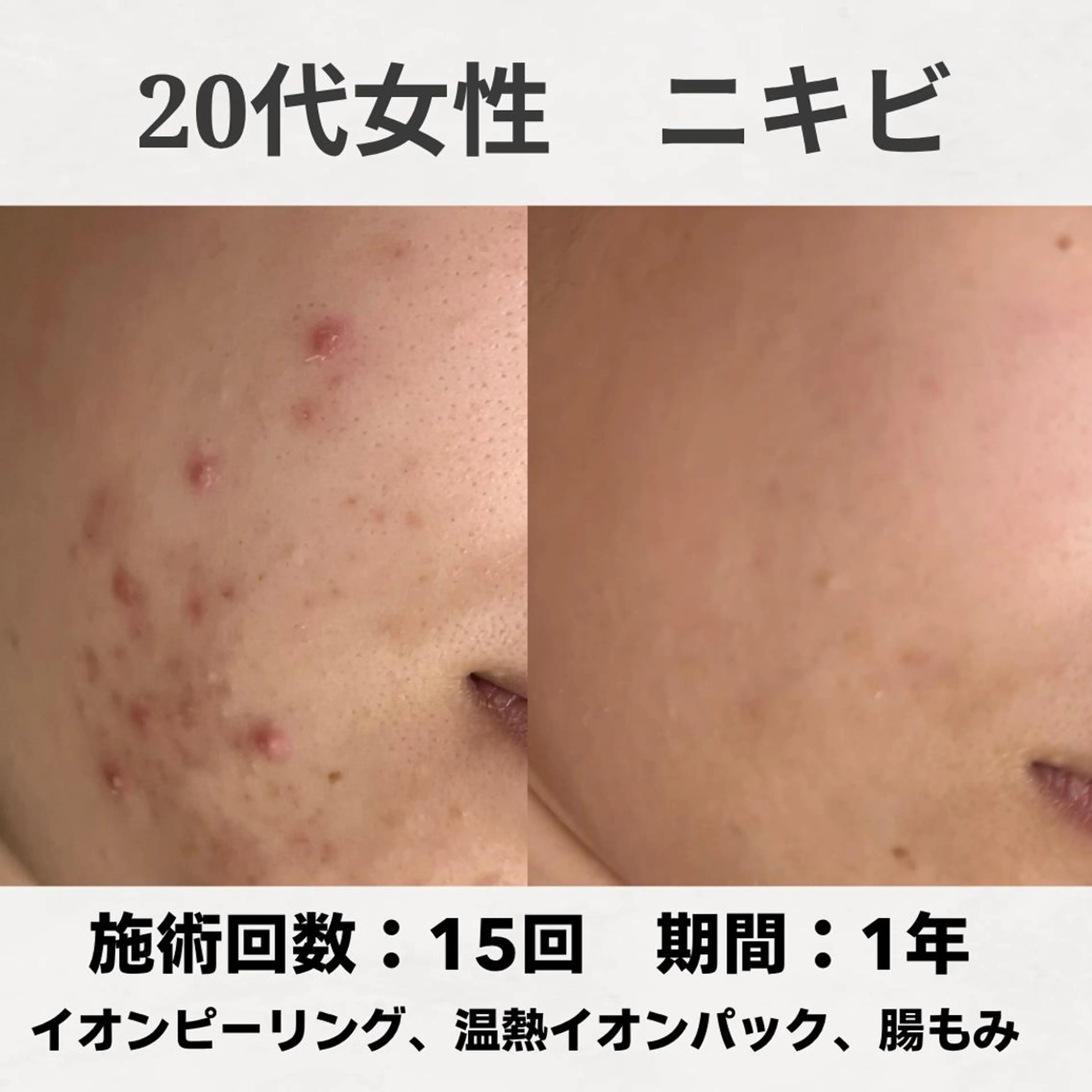 エステ リラク ニキビ跡改善専門🔥 医療にはできない改善のエステ・リラクイメージ