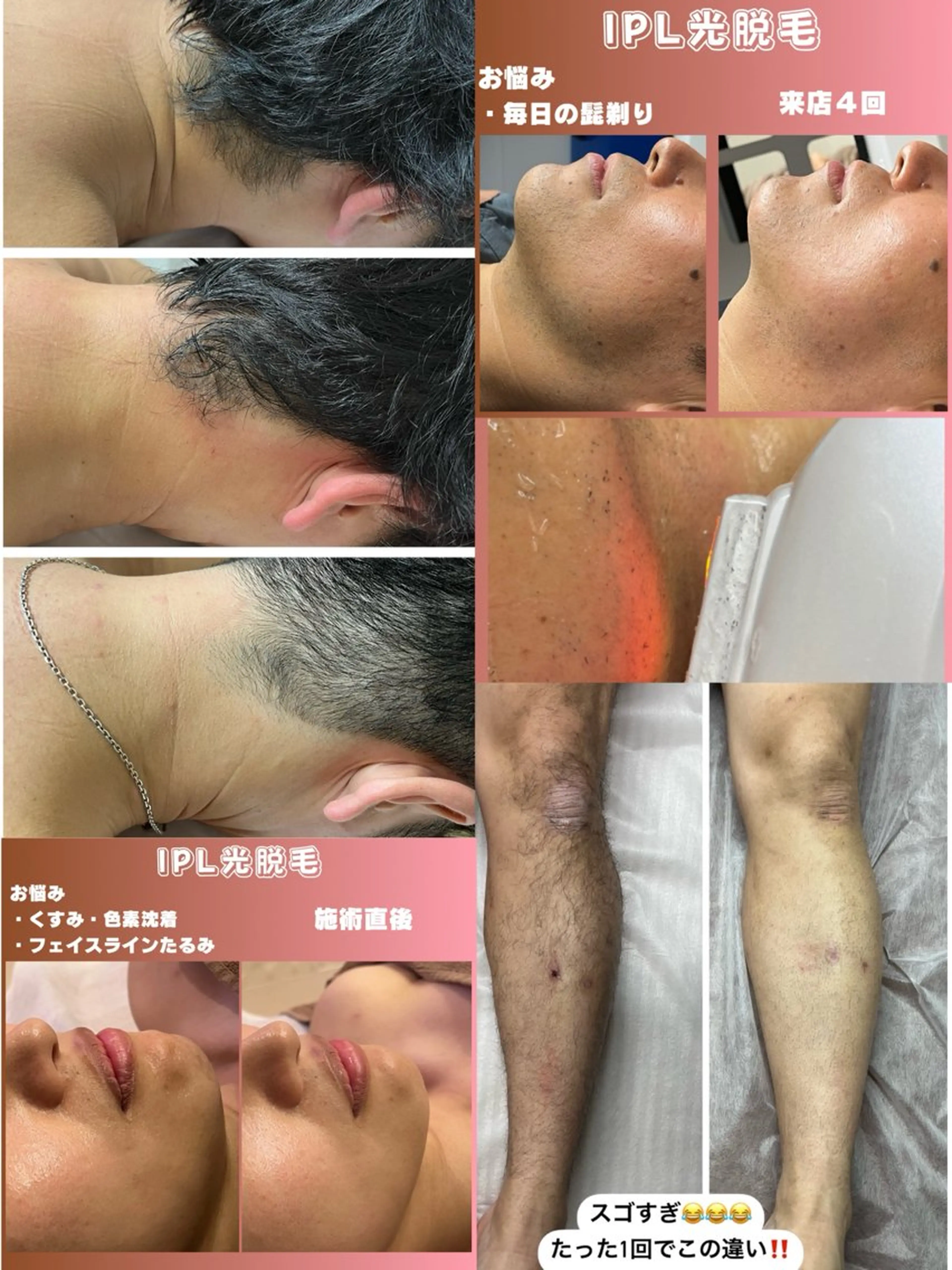 メンズ 肌質改善/都度脱毛 Mahinaのエステ・リラクイメージ