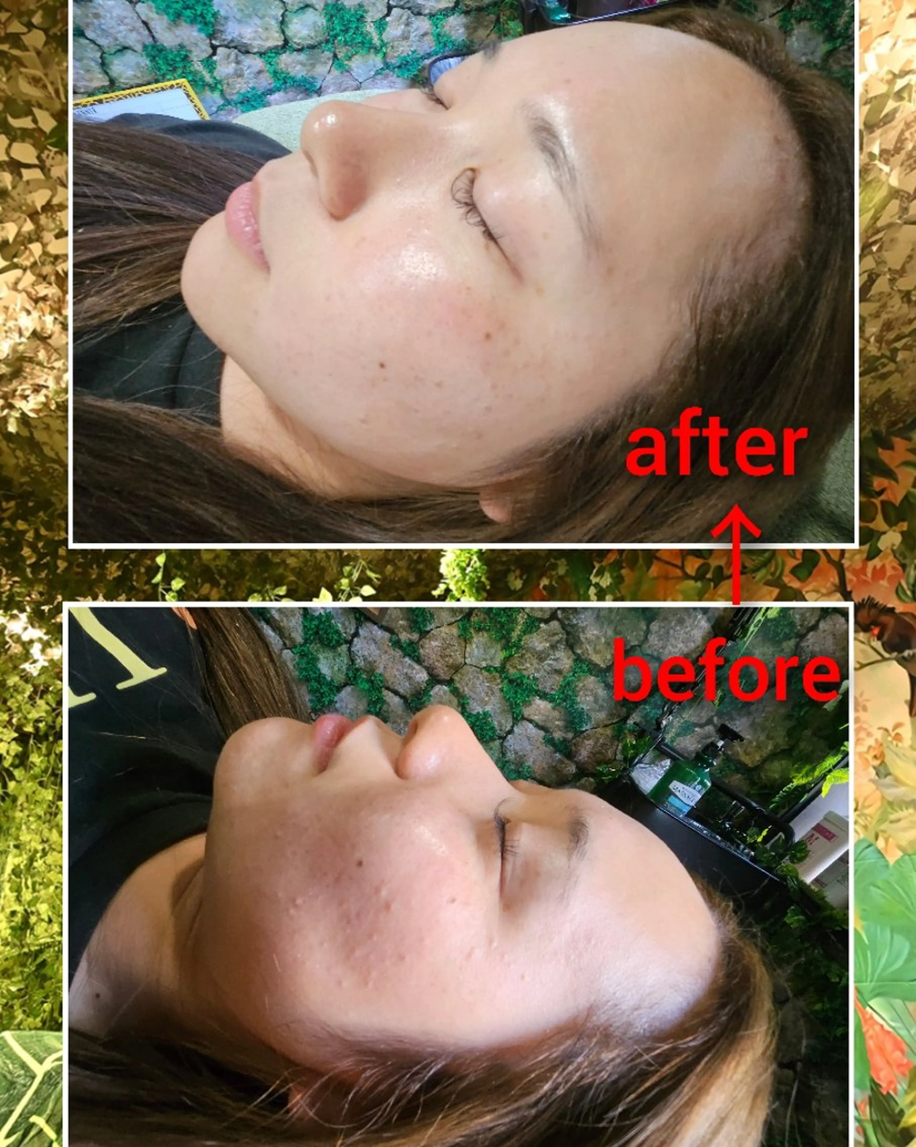 平日限定！リピーター様！ハーブピーリングの写真