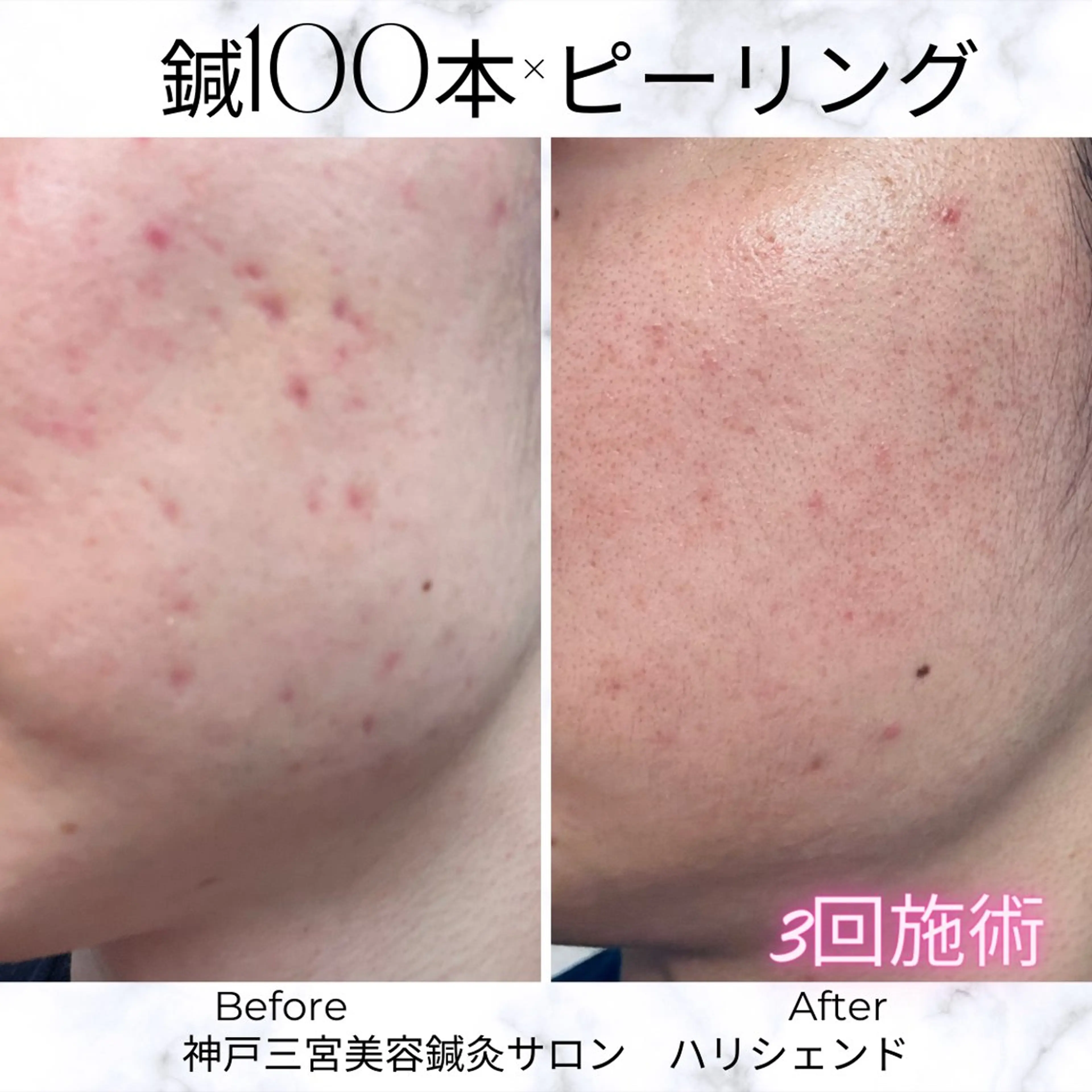 美容鍼・小顔矯正 ハリシェンドのエステ・リラクイメージ