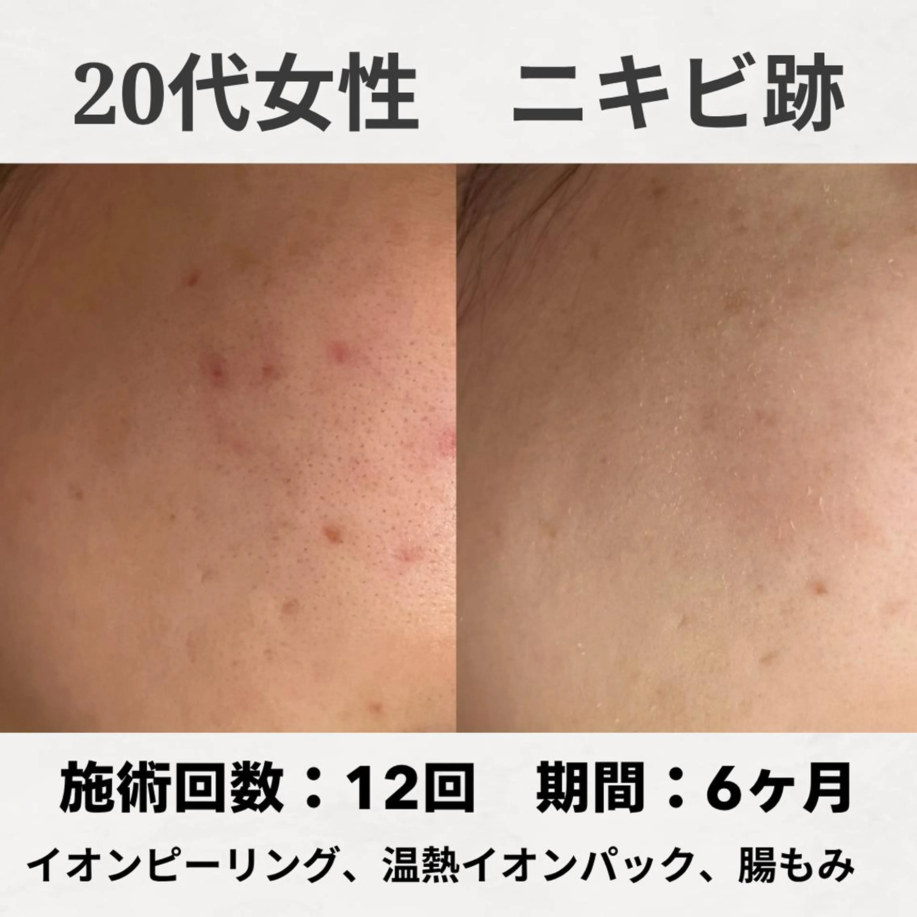 エステ リラク ニキビ跡改善専門🔥 医療にはできない改善のエステ・リラクイメージ