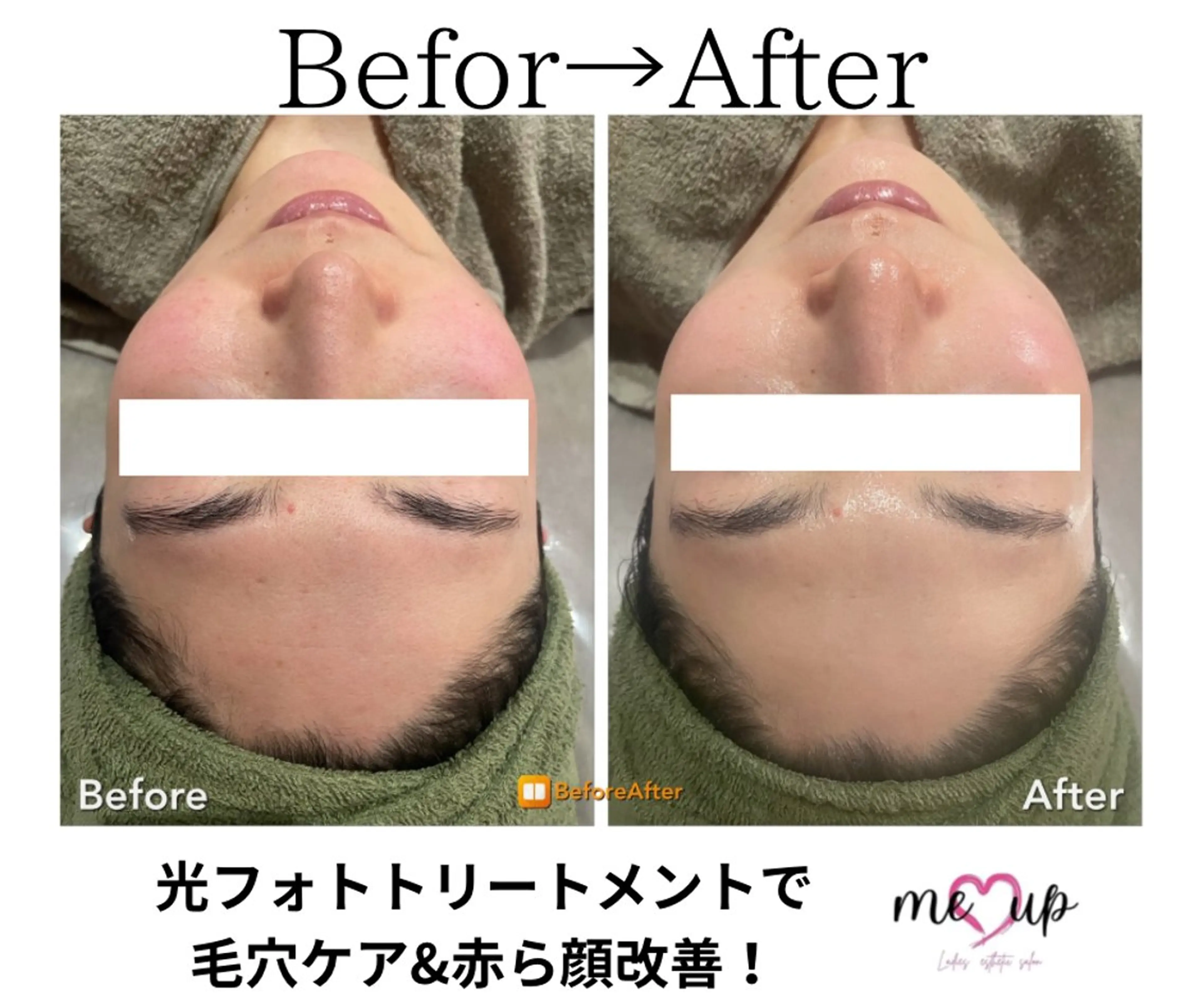 エステ Meupニキビ専門店 背中/ハーブ/肌管理のその他イメージ