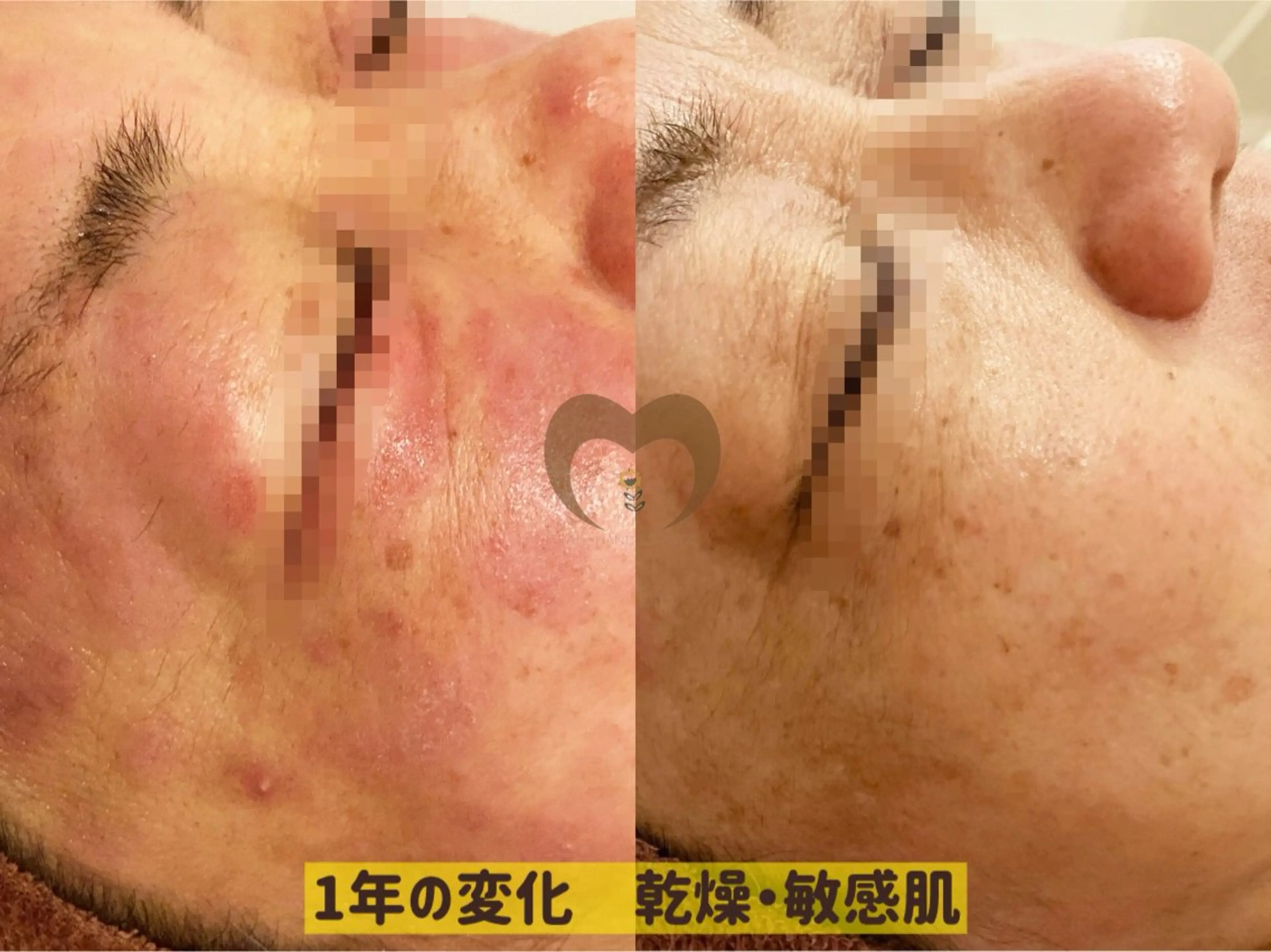 エステ リラク 繰り返すニキビ・毛穴 ✨つくば肌質改善専門のエステ・リラクイメージ